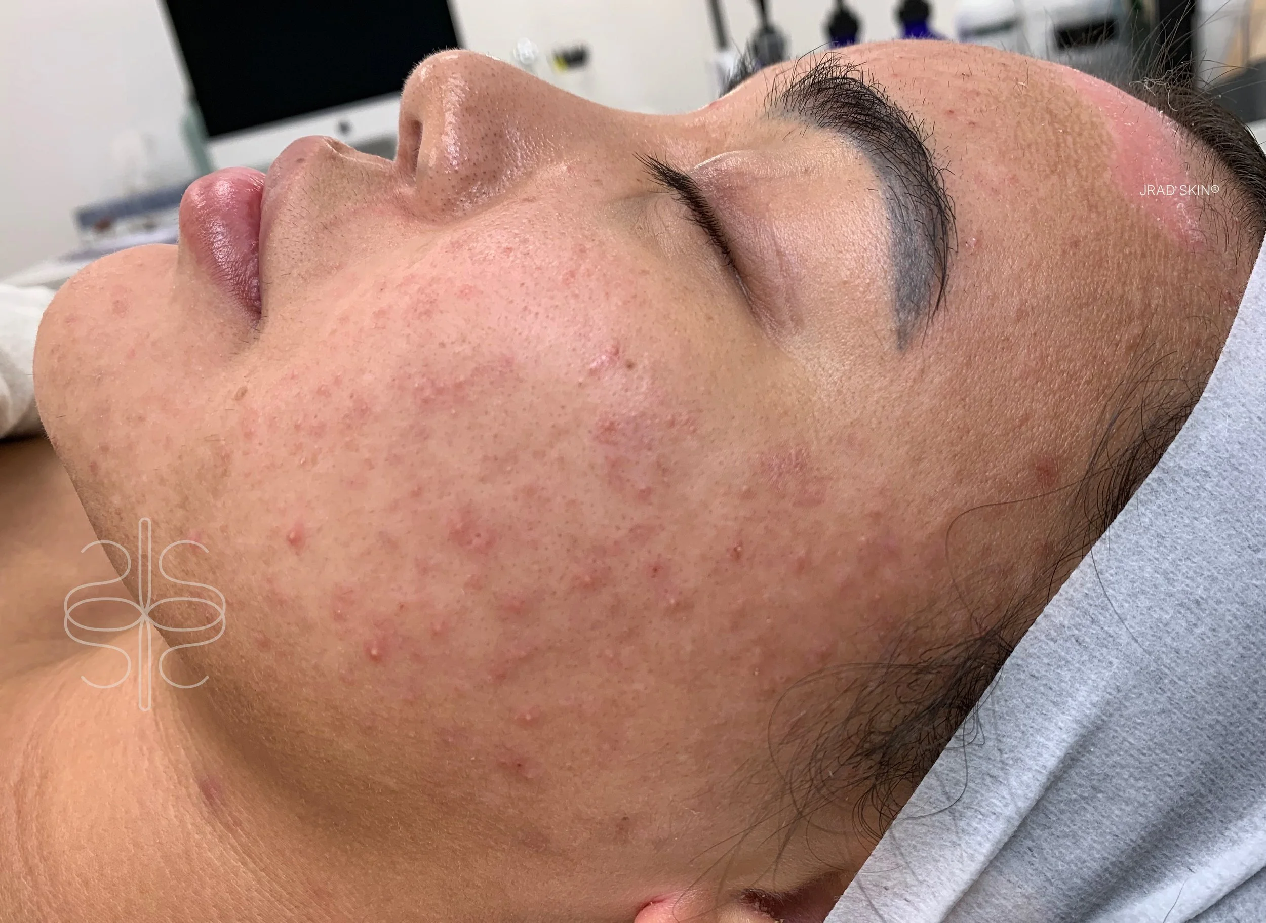 Before side-profile image of Shaelynn showing visible redness, congestion and post-inflammatory pigmentation across the cheek before JRAD SKIN treatment.