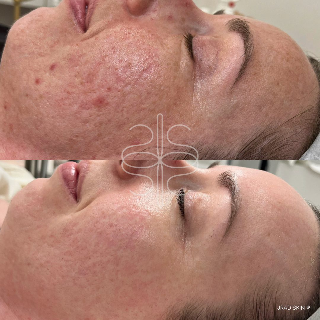 Before and after side-profile skin image showing improvement in visible redness, congestion and uneven texture along the cheek