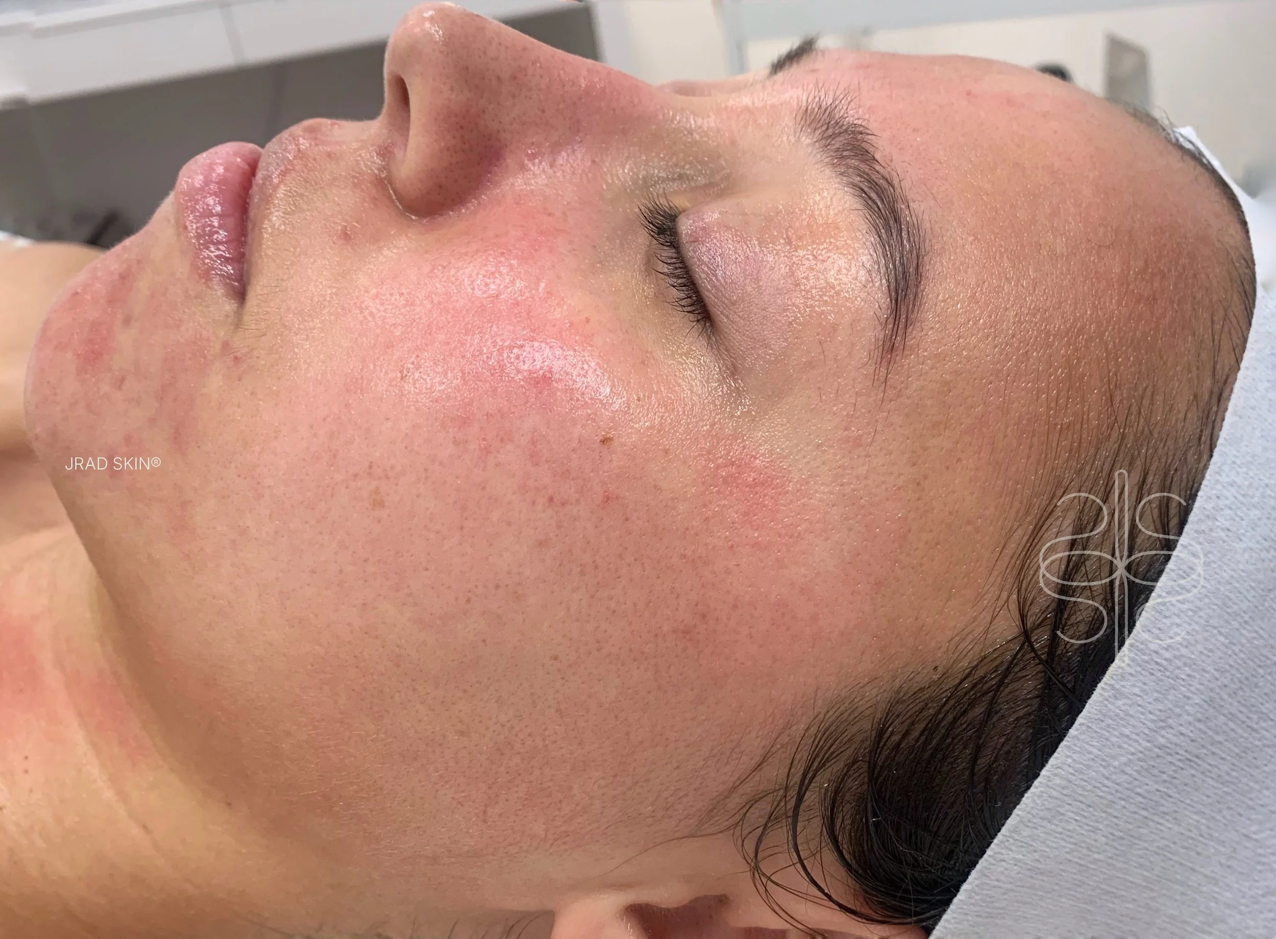 After side-profile image showing softened redness, improved-looking clarity and fewer visible breakouts along the cheek and jawline.