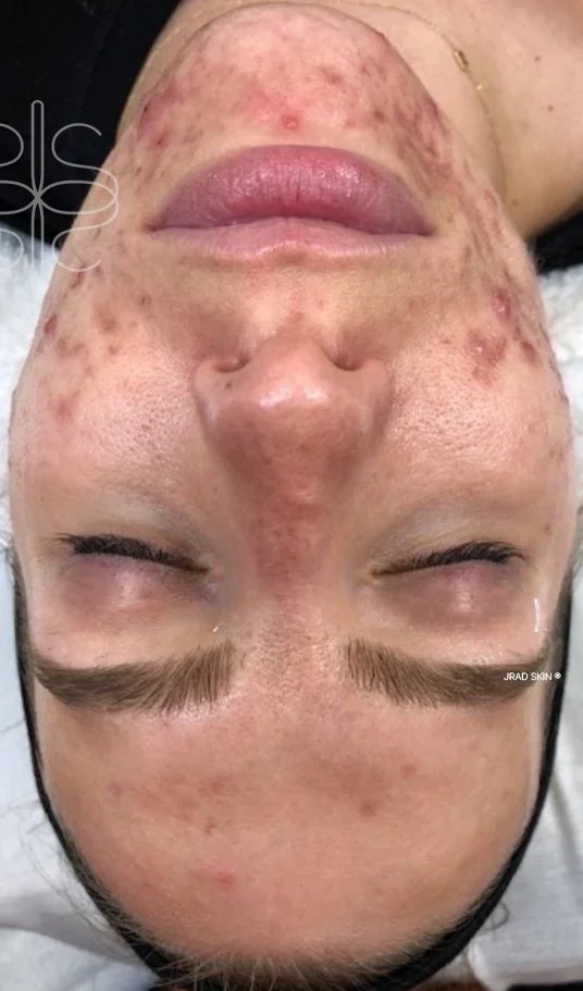 Before front-facing image showing cystic acne, congestion, redness and visible acne scarring across the cheeks, chin and lower face.