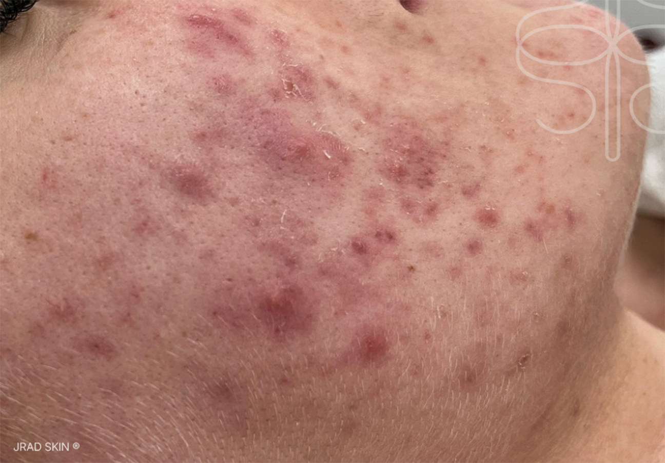 Before close-up image showing hormonal acne, inflamed blemishes, uneven texture and post-inflammatory pigmentation on the lower cheek and chin
