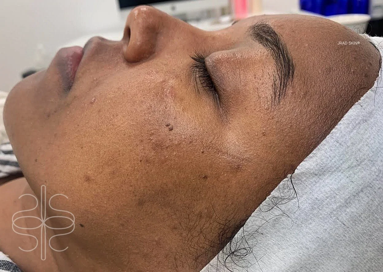 Before side-profile image of a Black woman showing pigmentation, rough texture and congestion along the cheek and jawline