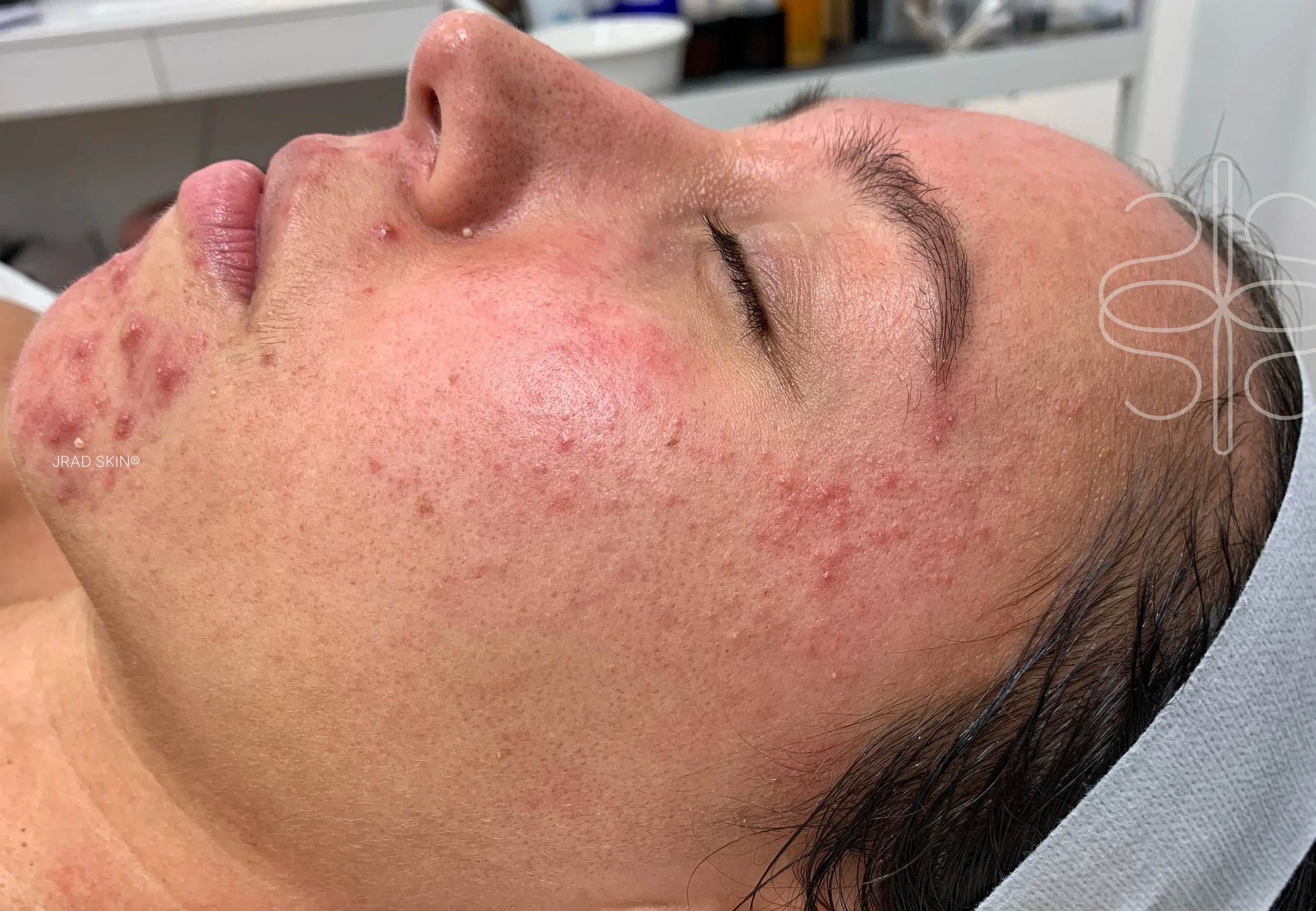 Before side-profile image showing redness, papulopustular rosacea and hormonal breakouts along the cheek, chin and jawline.