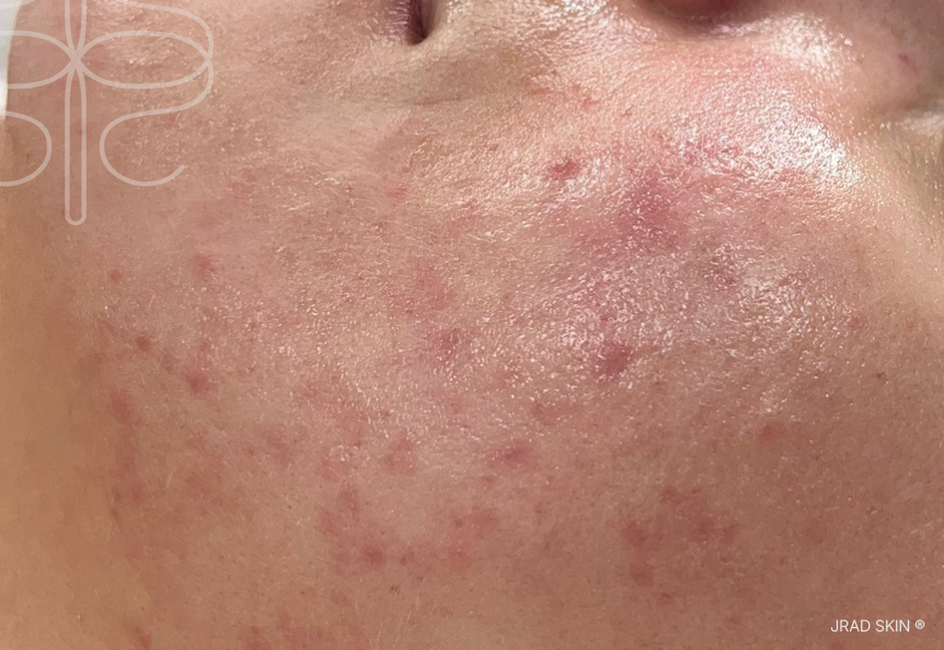 After cheek close-up showing calmer-looking skin with reduced visible redness, fewer active breakouts and softened post-acne marks
