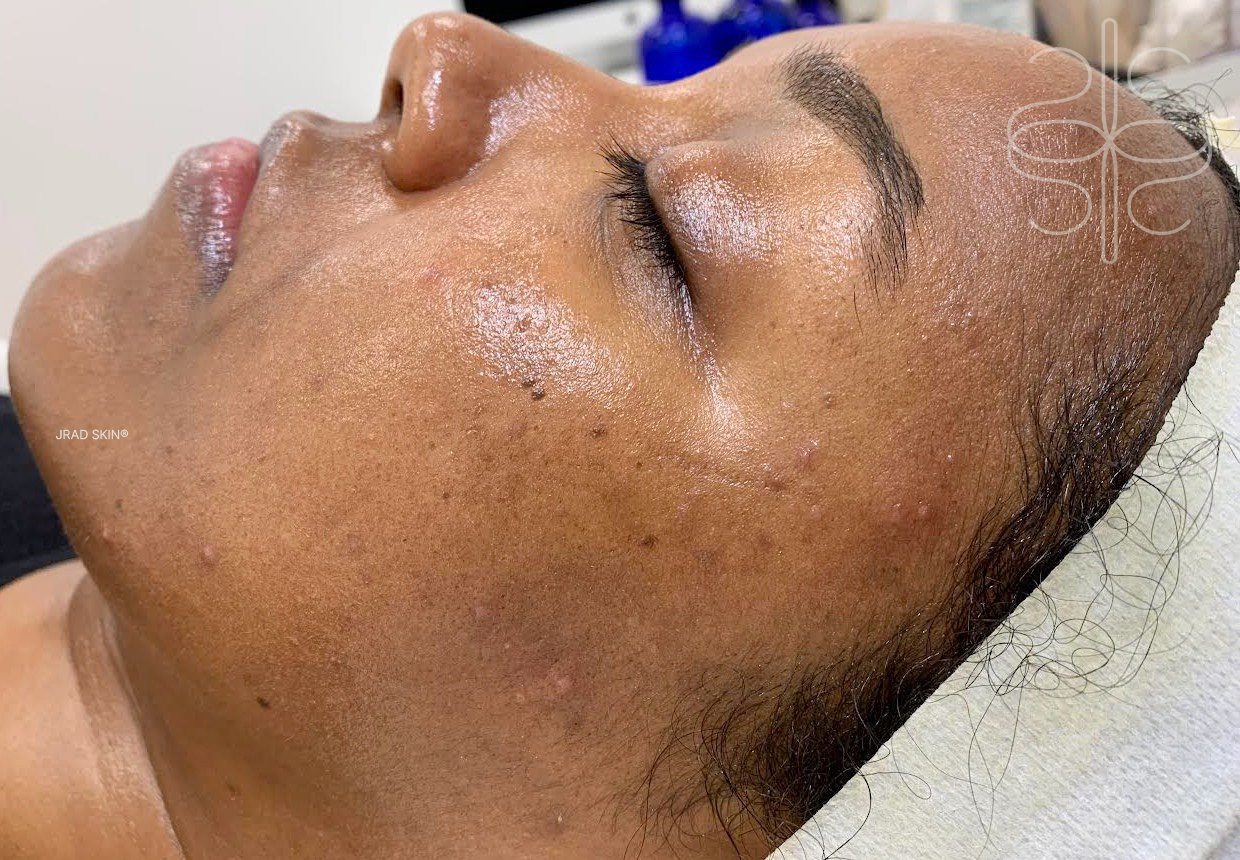 After side-profile image of a Black woman showing smoother-looking skin texture, softened pigmentation and improved visible clarity along the cheek
