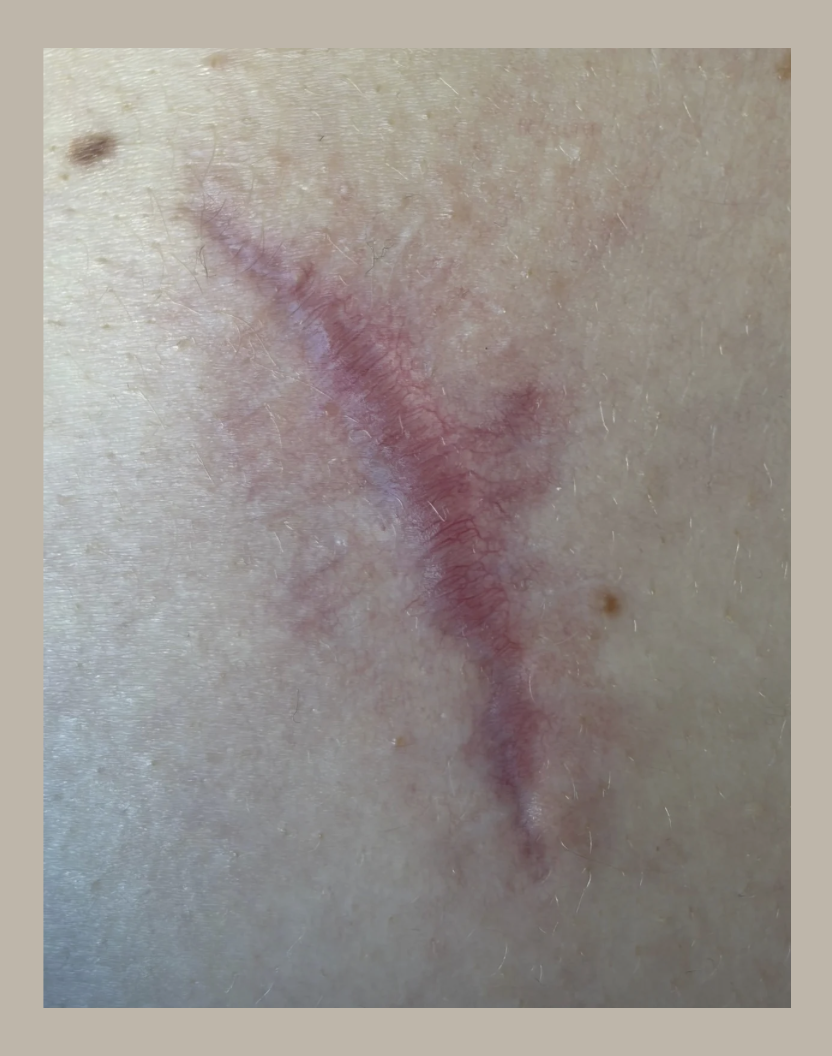 Post melanoma scar surgery healing scar