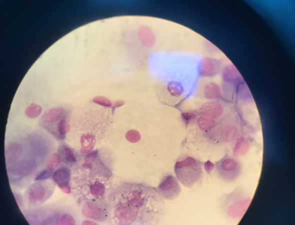 Could Exosomes from Menstrual Blood Help Treat Endometriosis?