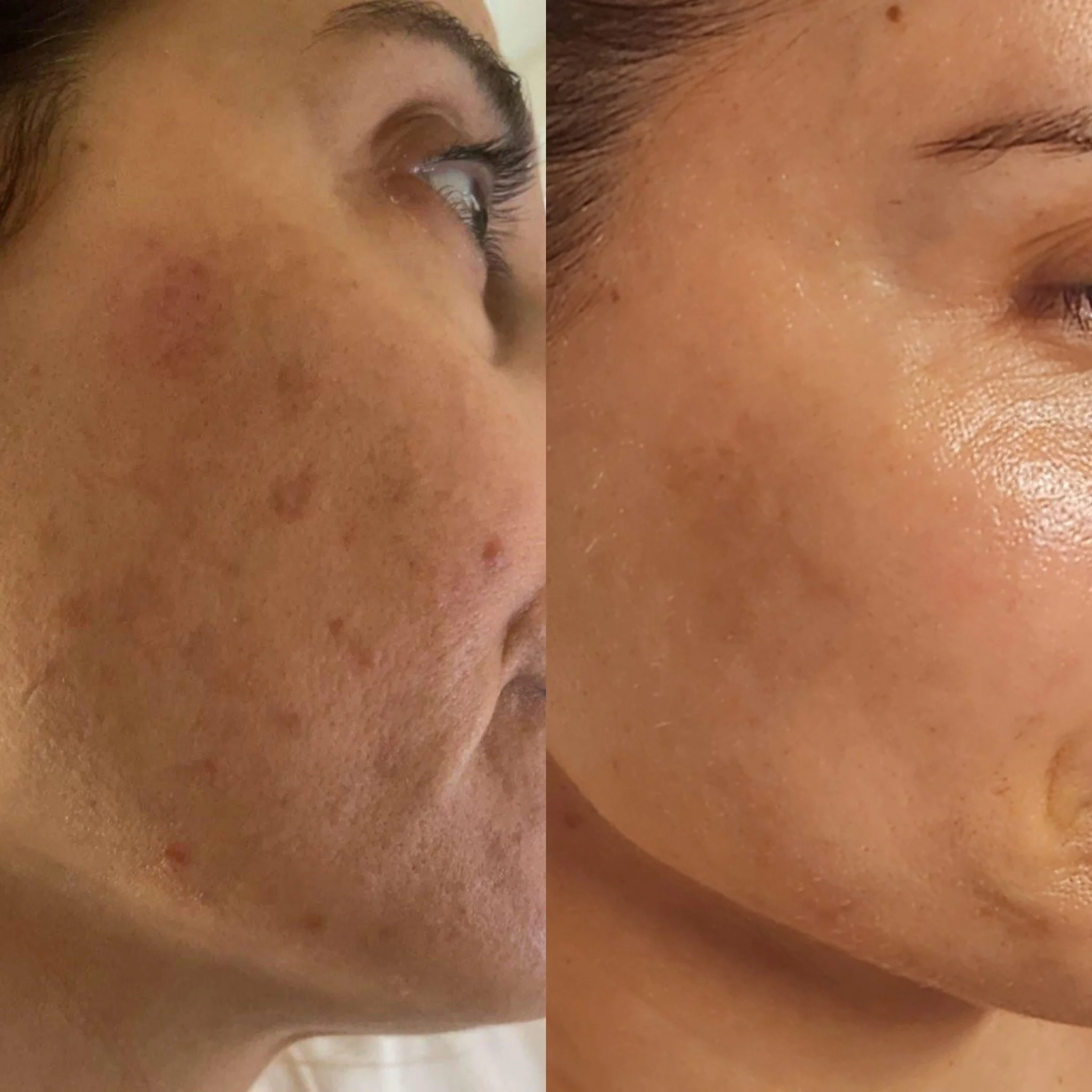 Side-by-side comparison of a person's face showing improvement in skin condition, with the left side showing acne scars and blemishes, and the right side showing clear, smooth skin.