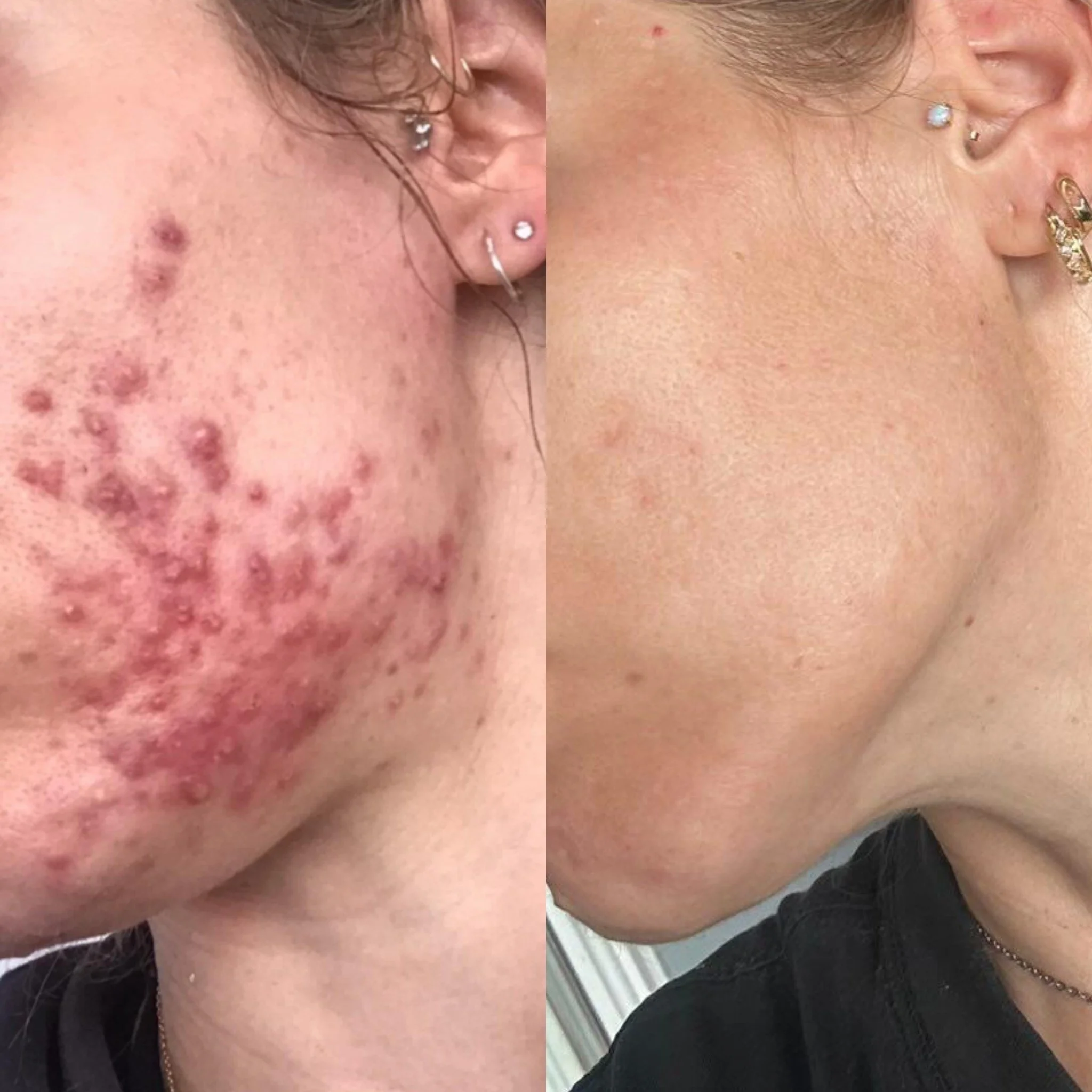 Before and after images showing a person's cheek, with significant improvement in acne scars and skin smoothness.