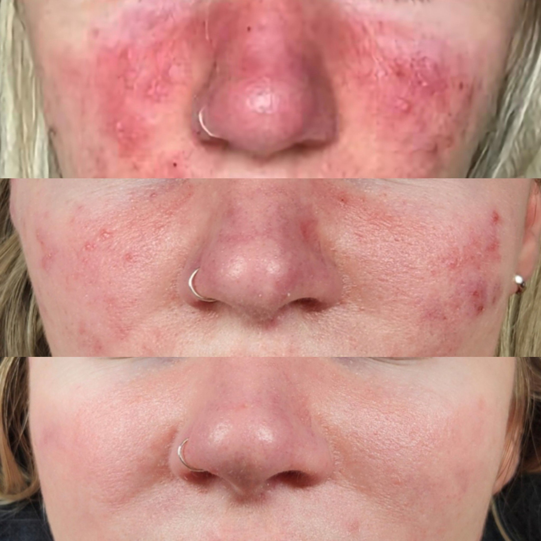 acne roseacea facesbykatey