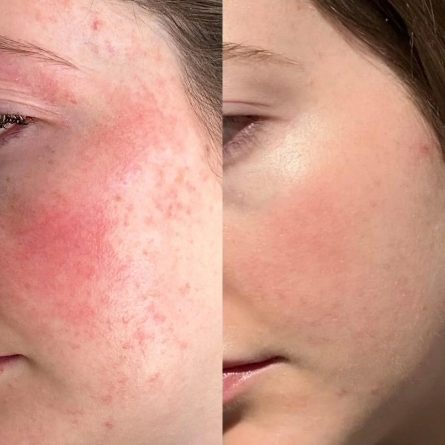 Helping others get their glow back is the best feeling.
 
Sometimes all you need is time, gentle care, and a little support. 💗
Anti-inflammatory super heros Rescue Epidermal Repair Serum + SIV were part of her routine.
1 month apart.
www.facesbyk