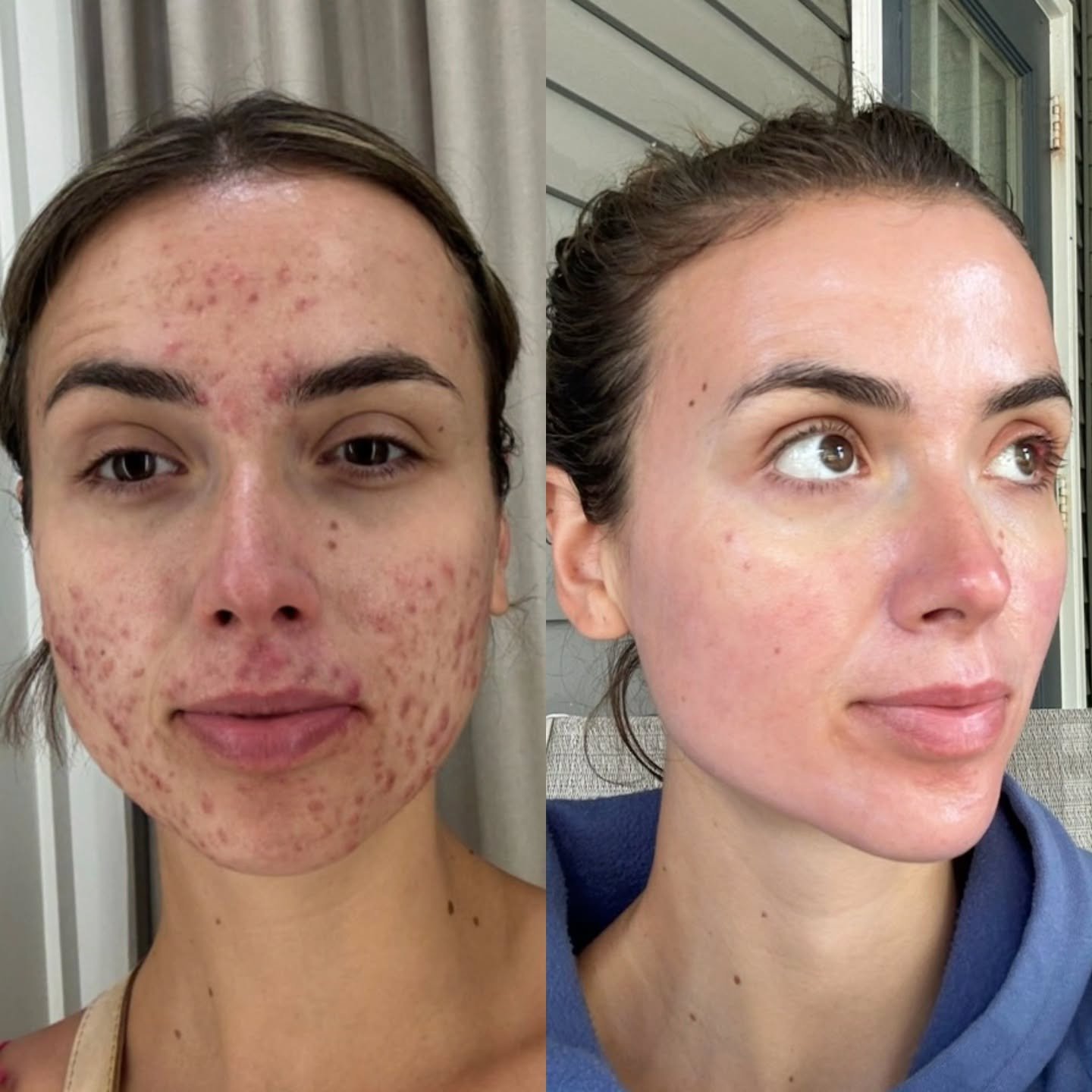 Your acne doesn't have to be forever 🎀

&amp; you don't have to go through your clear skin journey alone. 

Let's achieve your glow goals together.

Virtual holistic skin consultations , personalized routines, esthetician approved skincare: 

www.fa