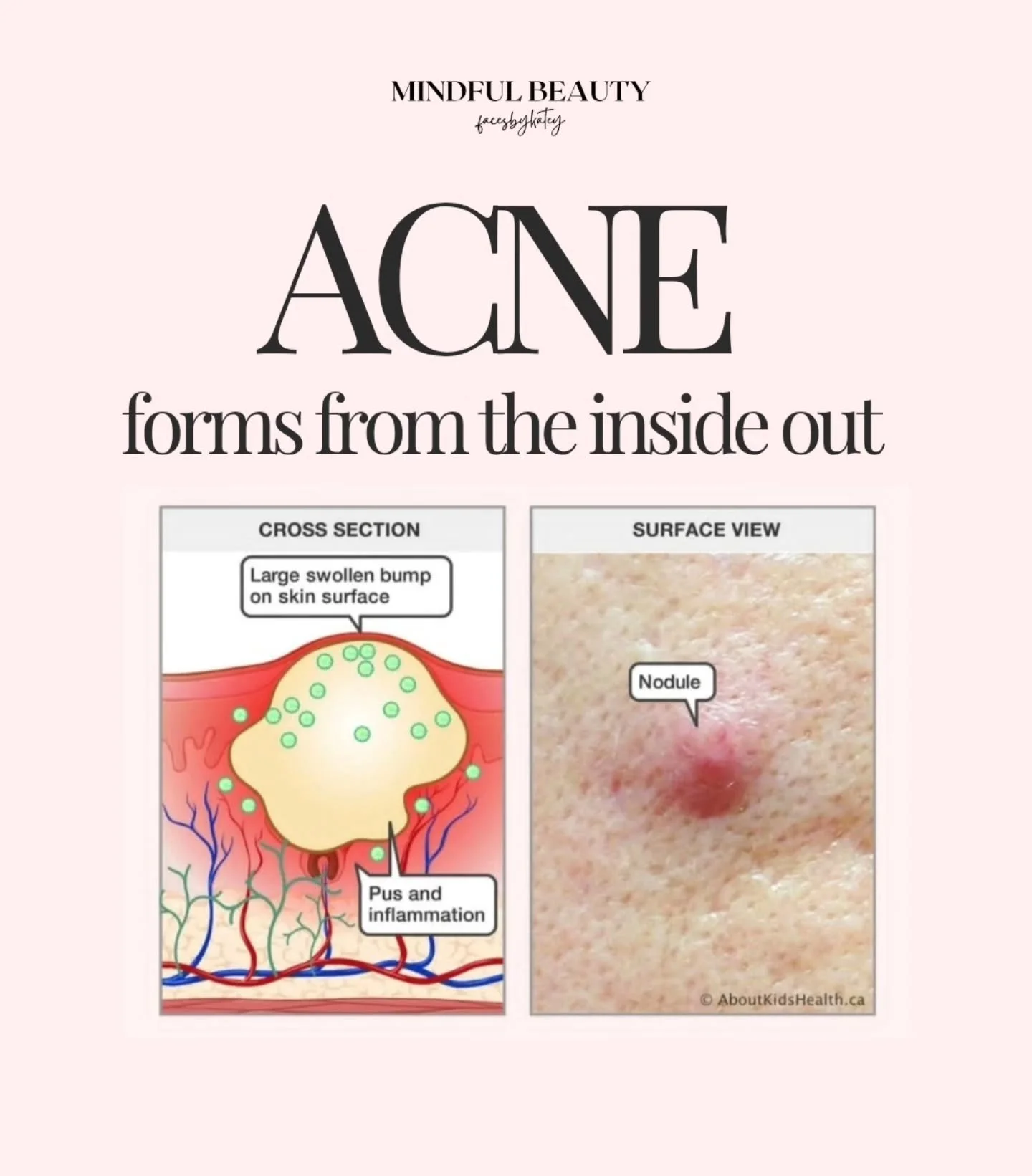 Acne forms from the inside out, not the outside in, so we can't only approach clearing it from the surface.

Clear skin is built internally, supported topically, and reflected externally✨️

Skincare is important to balance the ways acne  manifests on