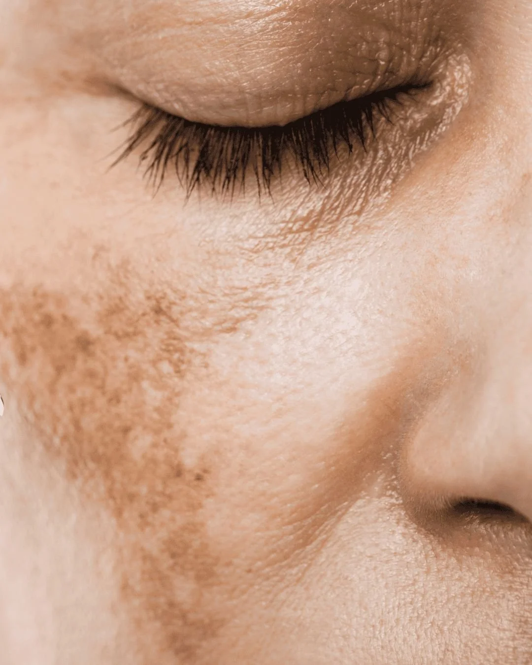 Tyrosinase Inhibitor Skincare for Dark Spots