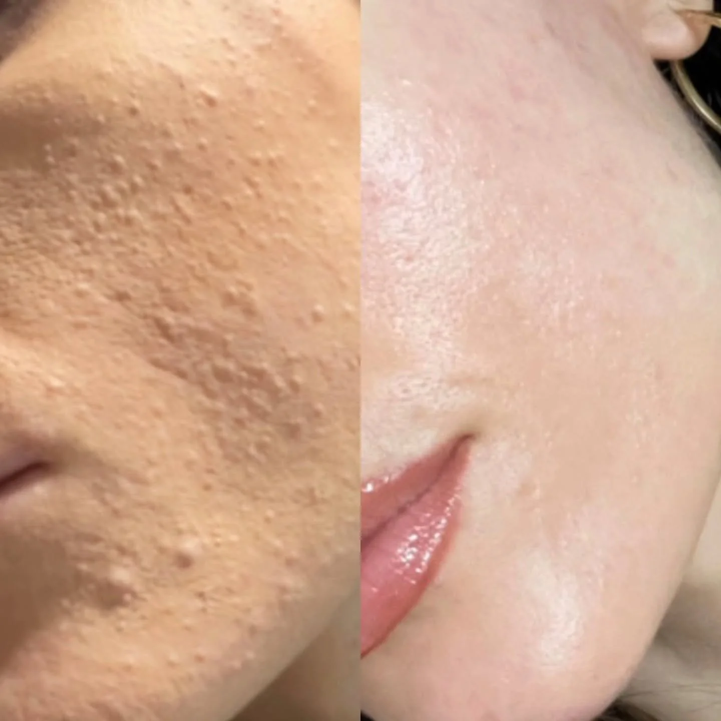 Closed comedones and maturation-arrest acne are often more difficult to clear than inflamed acne.

Closed comedones are tiny, flesh-coloured or white bumps that sit under the surface of the skin.
They&rsquo;re made up of:

&bull; Compact, sticky dead