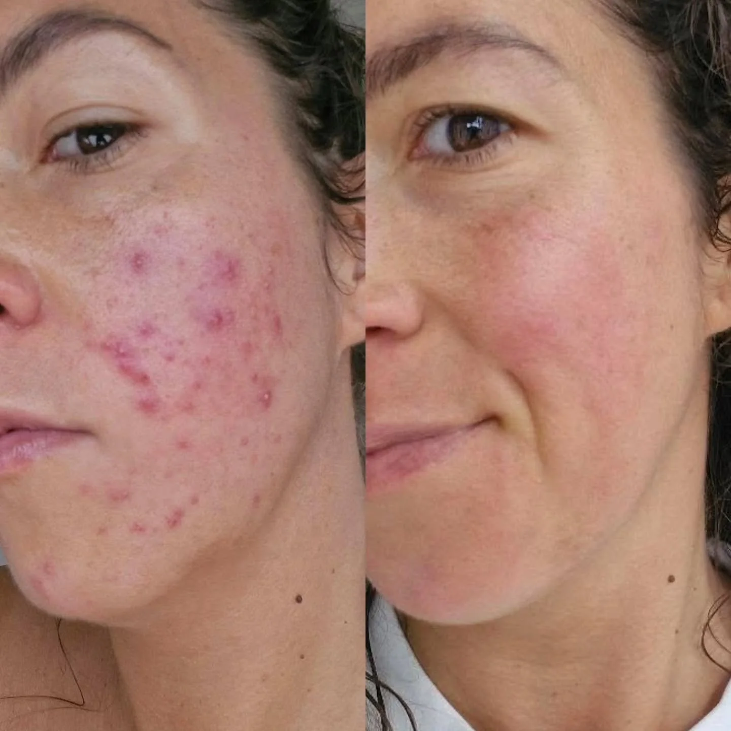 Another day, another glowing skin transformation.

My favorite part about B&amp;A's isn&rsquo;t just helping someone with their skin &mdash; it&rsquo;s seeing the energy shift that comes along with it too. 

Thank you for trusting me to be part of yo