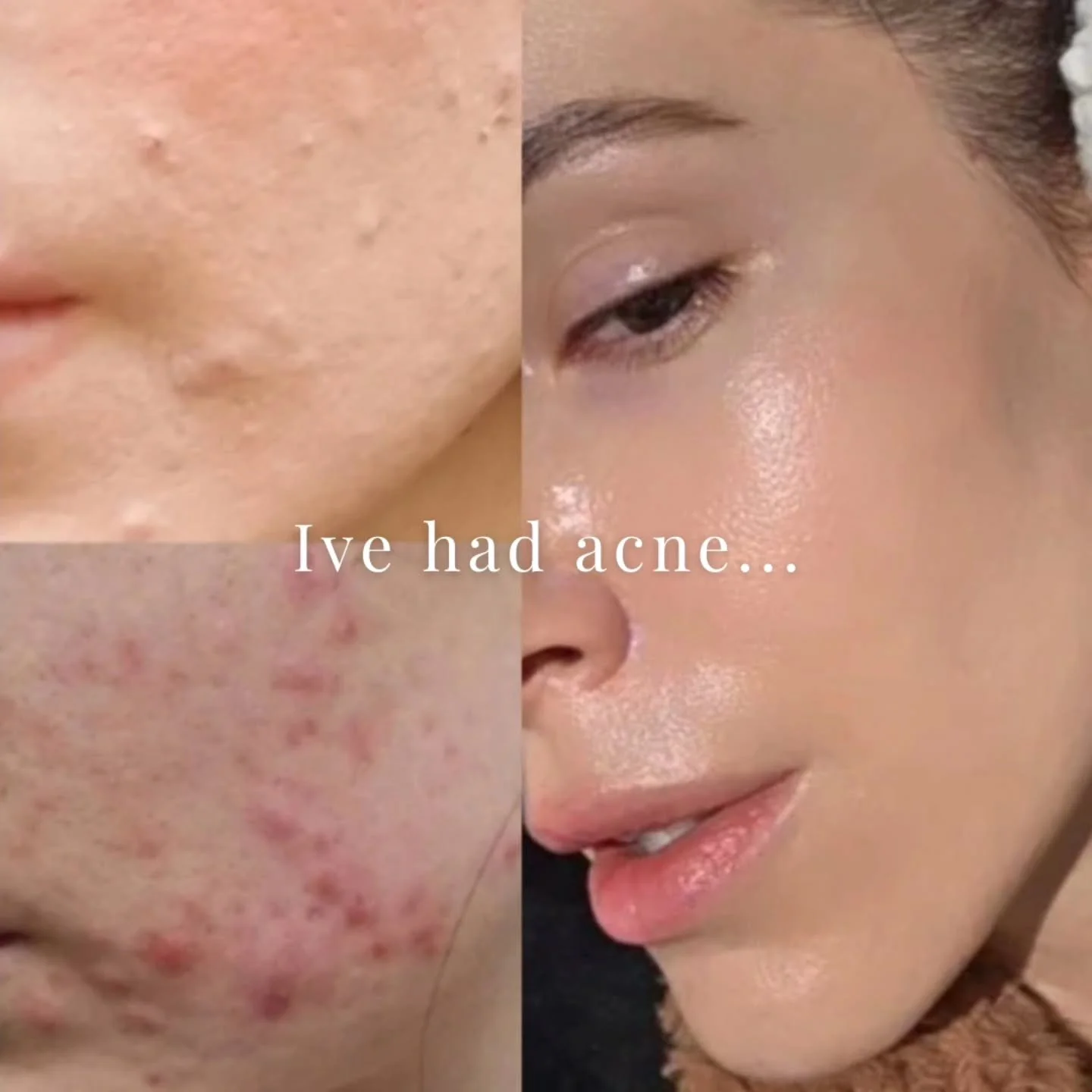 I know what it feels like to feel disconnected from your own skin.

Along the way I've learned that real skin healing comes from balance.

Making the mind-body-skin connections is something that was helpful to both my clear skin clients &amp; I.

The