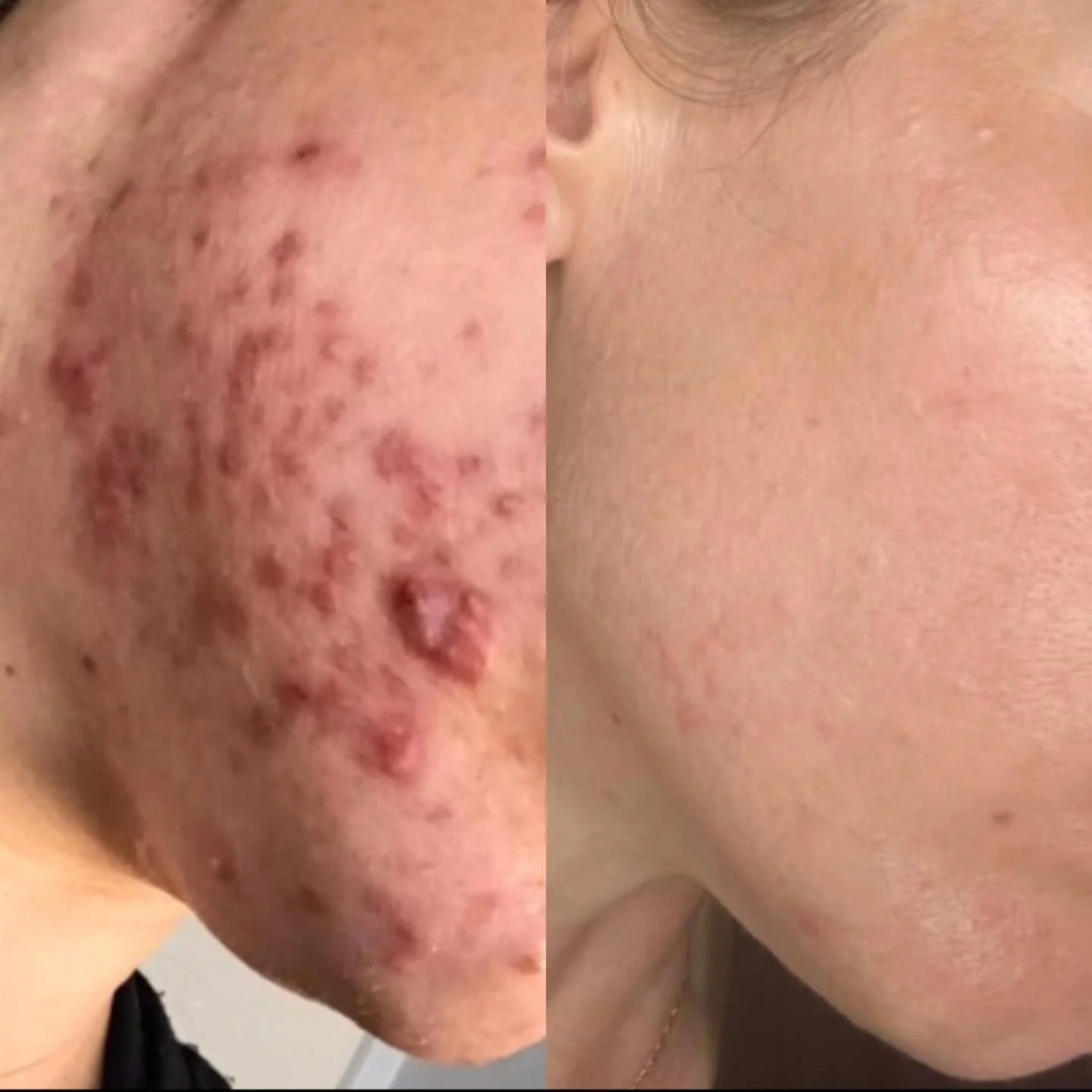 The proof is in the pudding 🍮 🪄

Grateful to be able to help others feel confident in there skin. 

💖
💖

Shop my curated skincare at www.facesbykatey.com