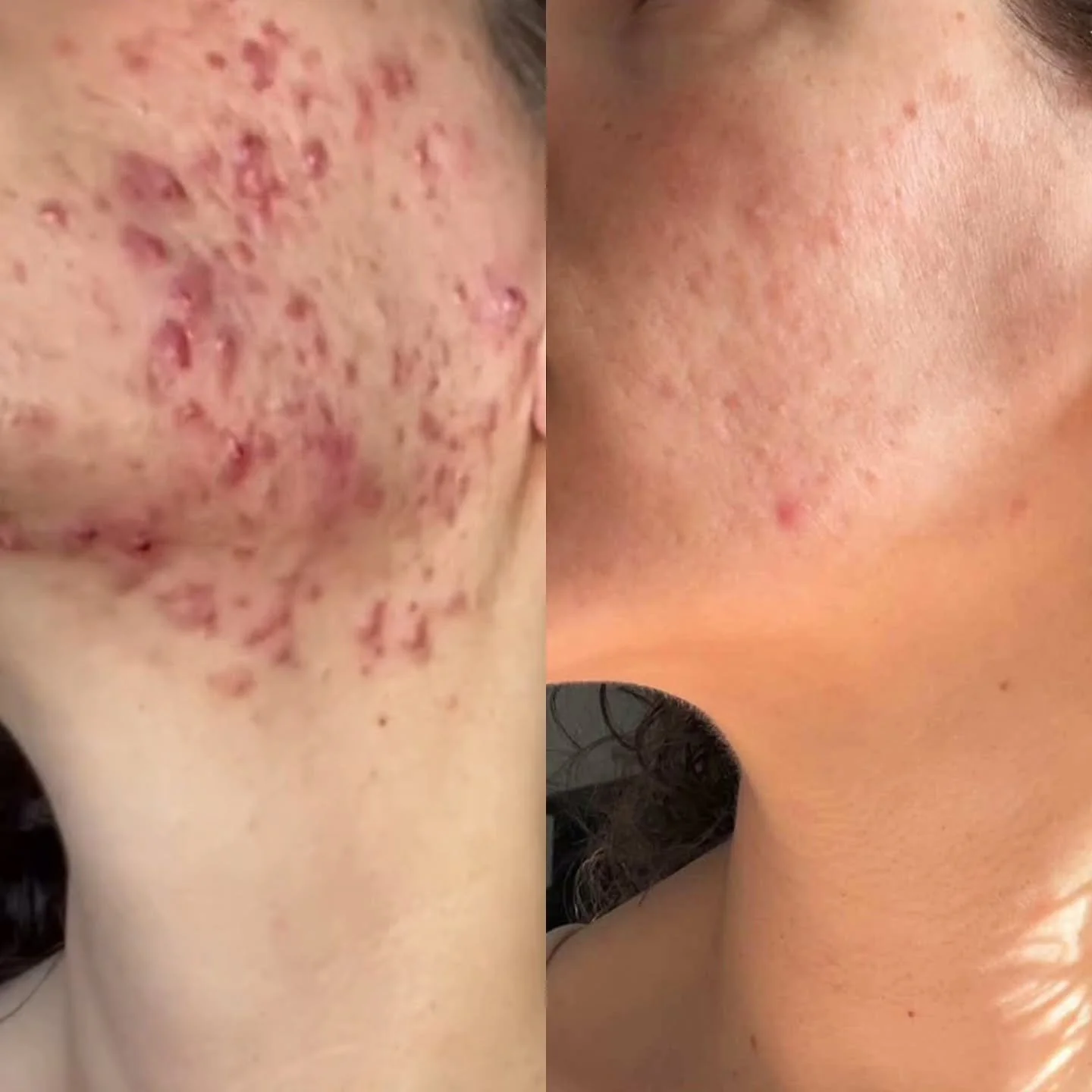 I couldn&rsquo;t be more proud of my beautiful client.

No Accutane. No prescriptions.

Just getting to the root, identifying the triggers, and recognizing the patterns behind chronic acne.

When we support the lymph&ndash;skin connection and stay co