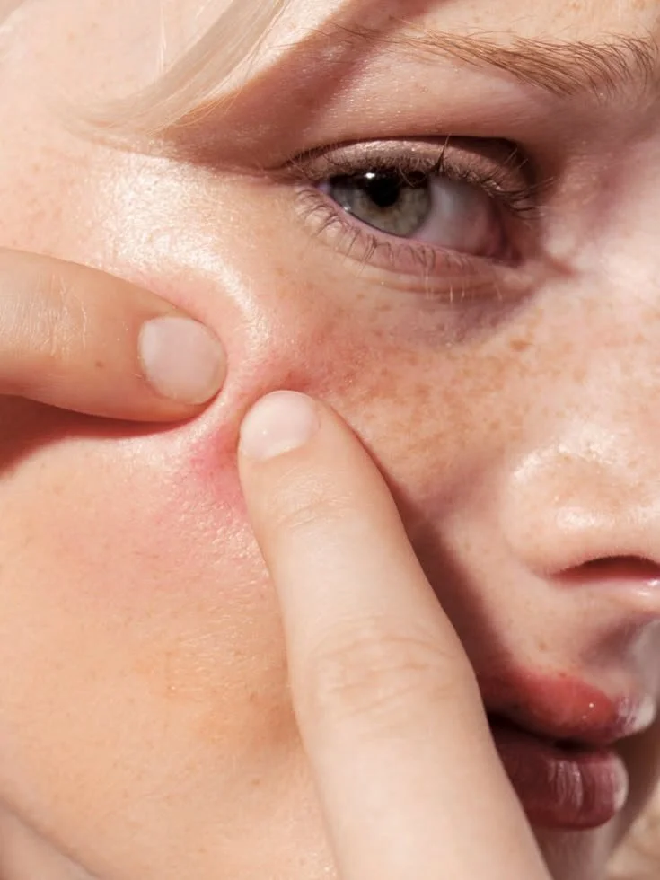 What to Do When You Have a Pimple: How to Stop Picking and Help a Blemish Heal