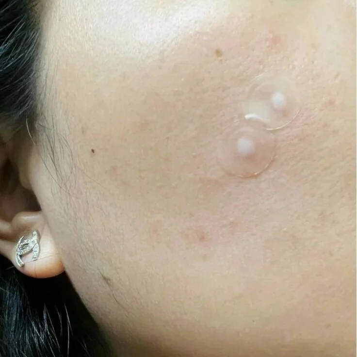 pimple patch pinterest