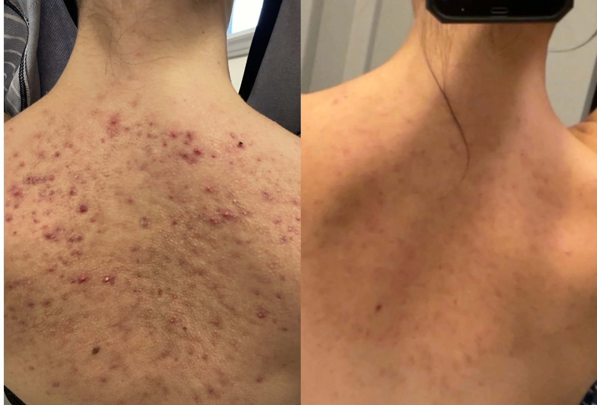 body acne before and after