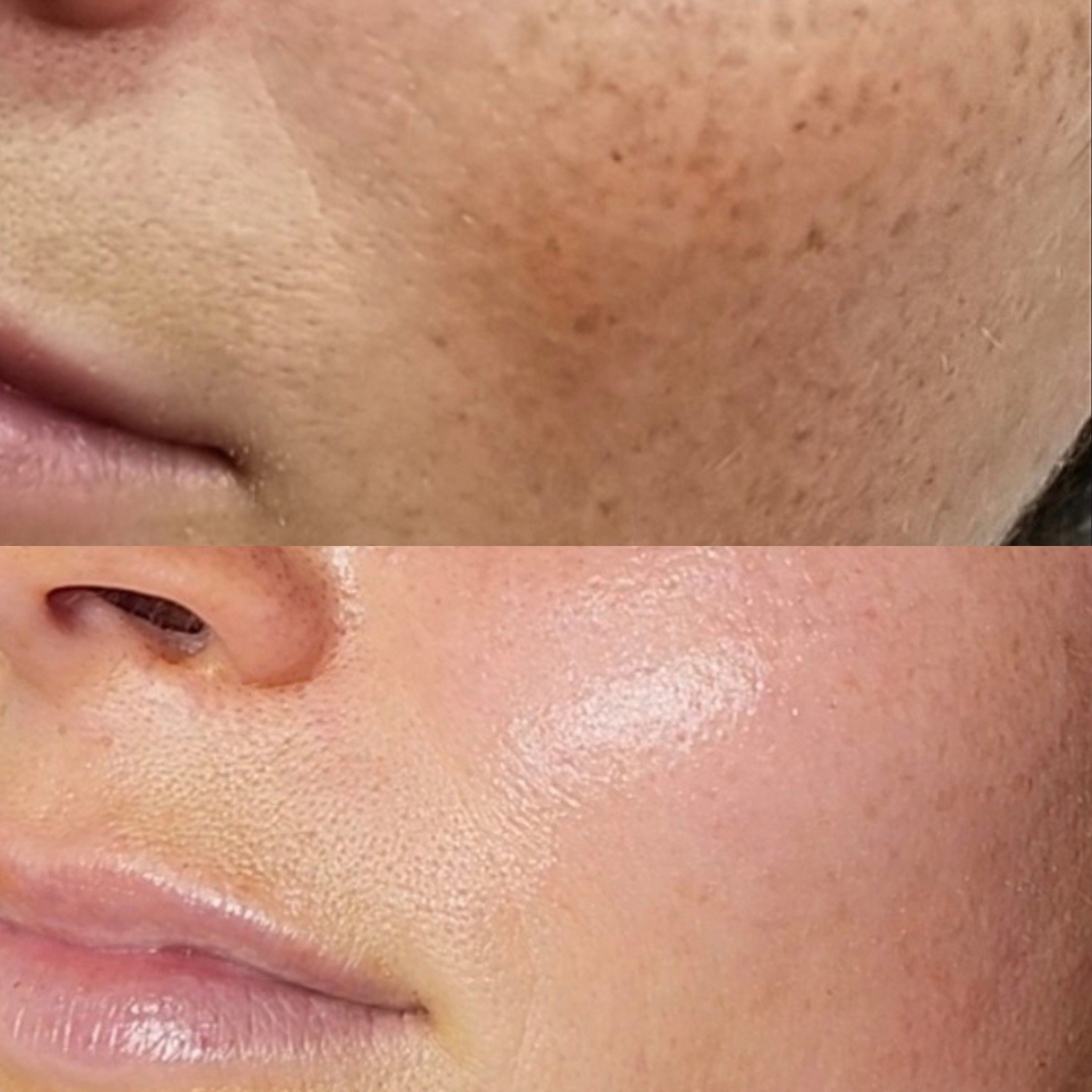 pigmentation before and after.