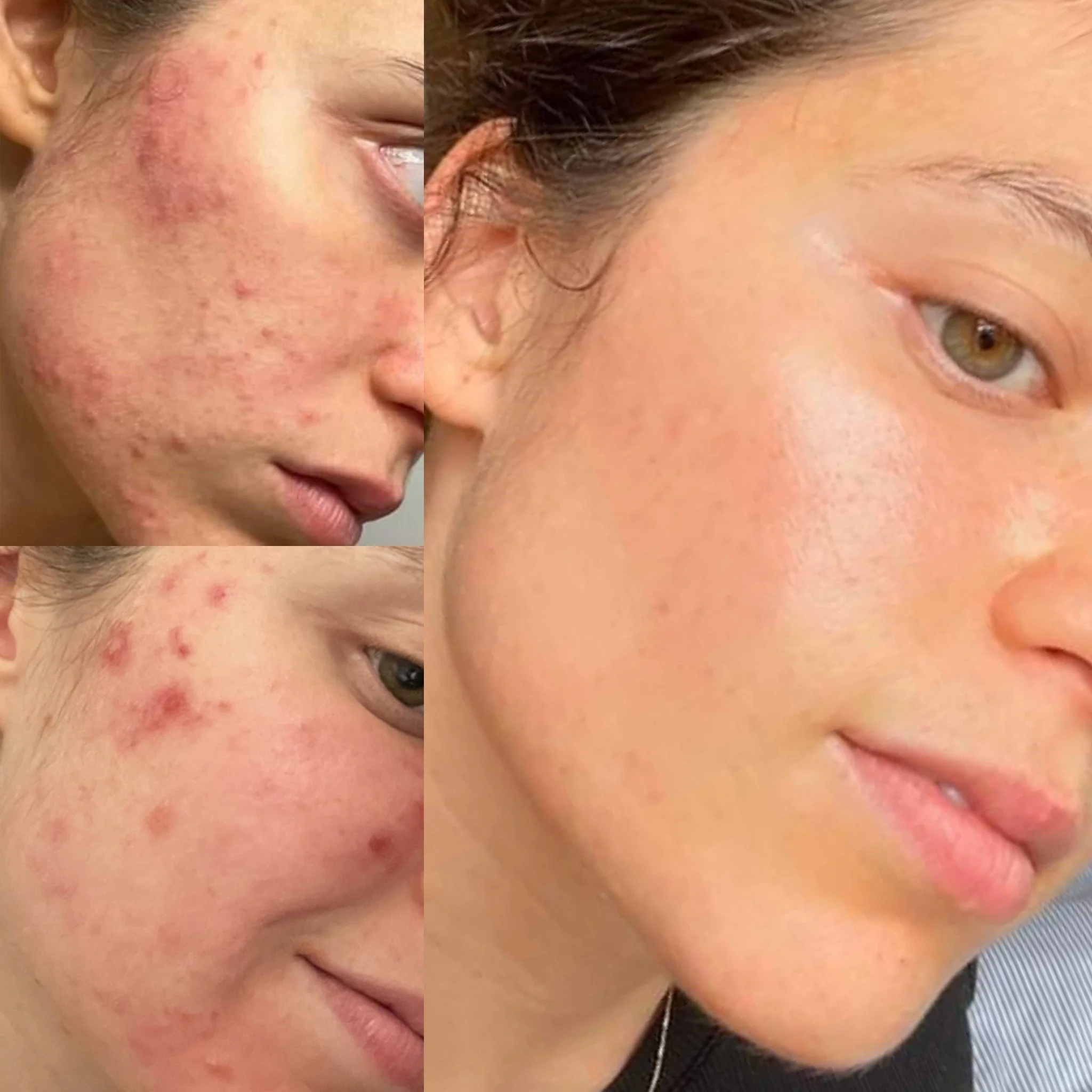 Before and after acne