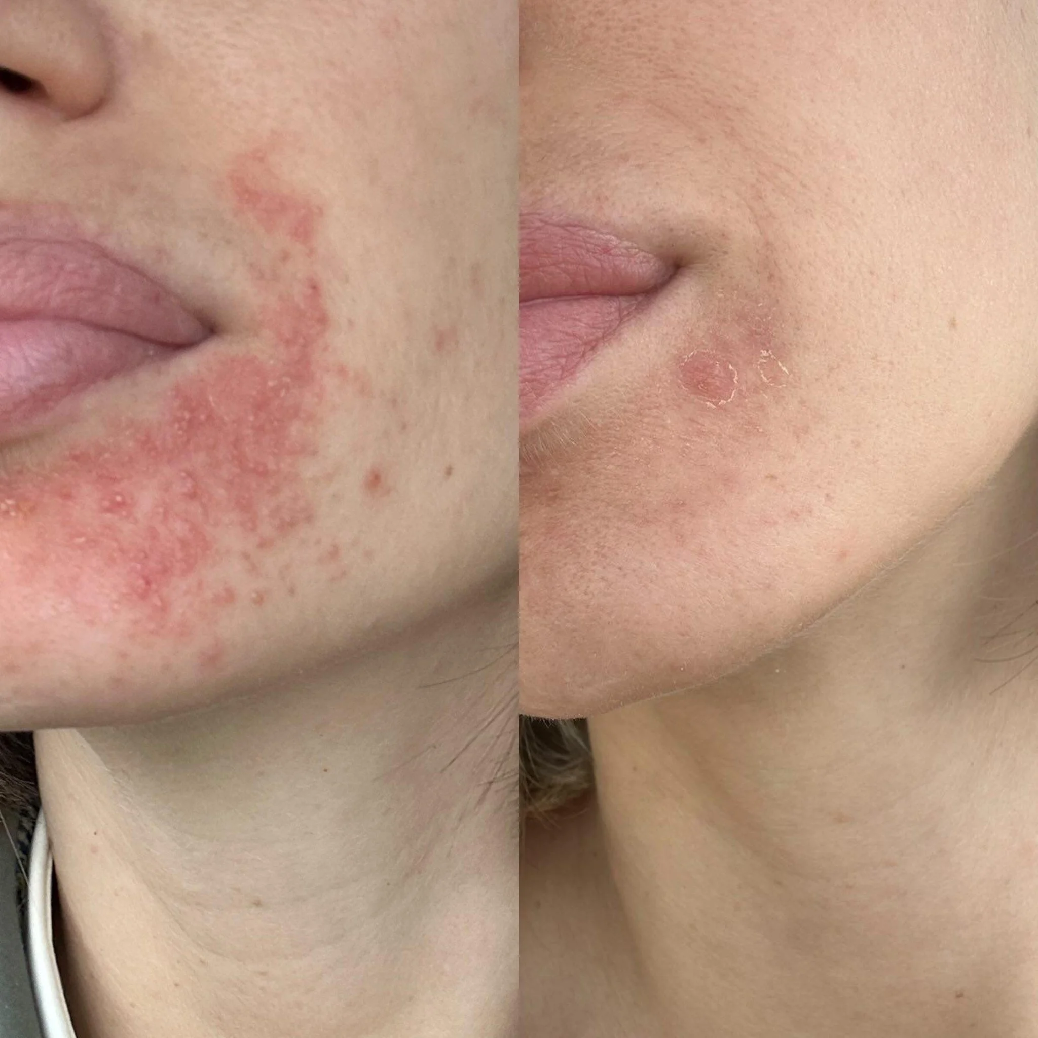 Side-by-side comparison of a person's face showing skin improvement; the left side shows red, acne-prone skin, and the right side shows clear, smooth skin.