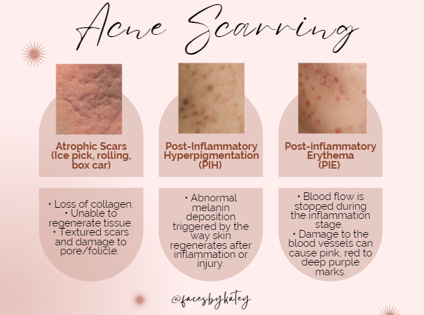 How To Get Rid Of Acne Scars — Mindful Beauty