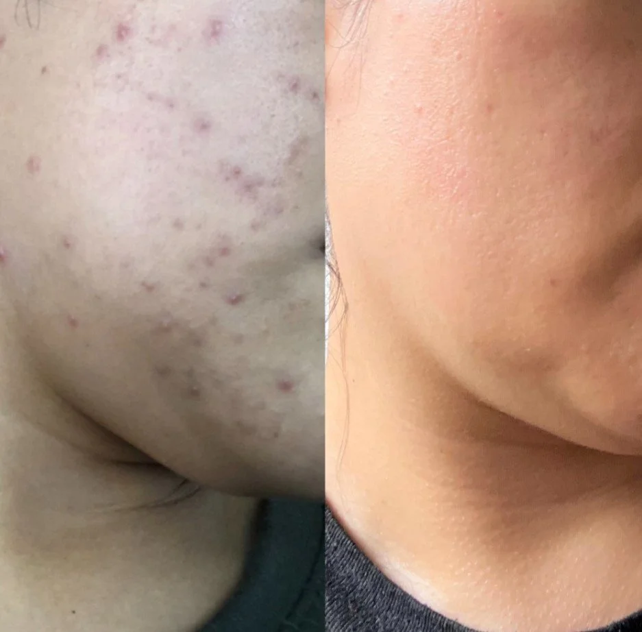 Side-by-side comparison of skin, with acne and scars on the left and clear, smooth skin on the right.