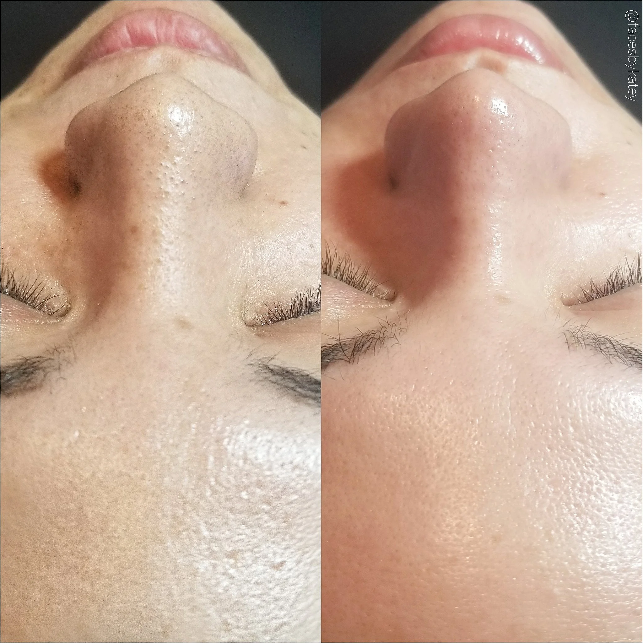 Hydrofacial 