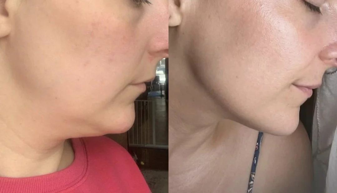 facesbykatey before and after