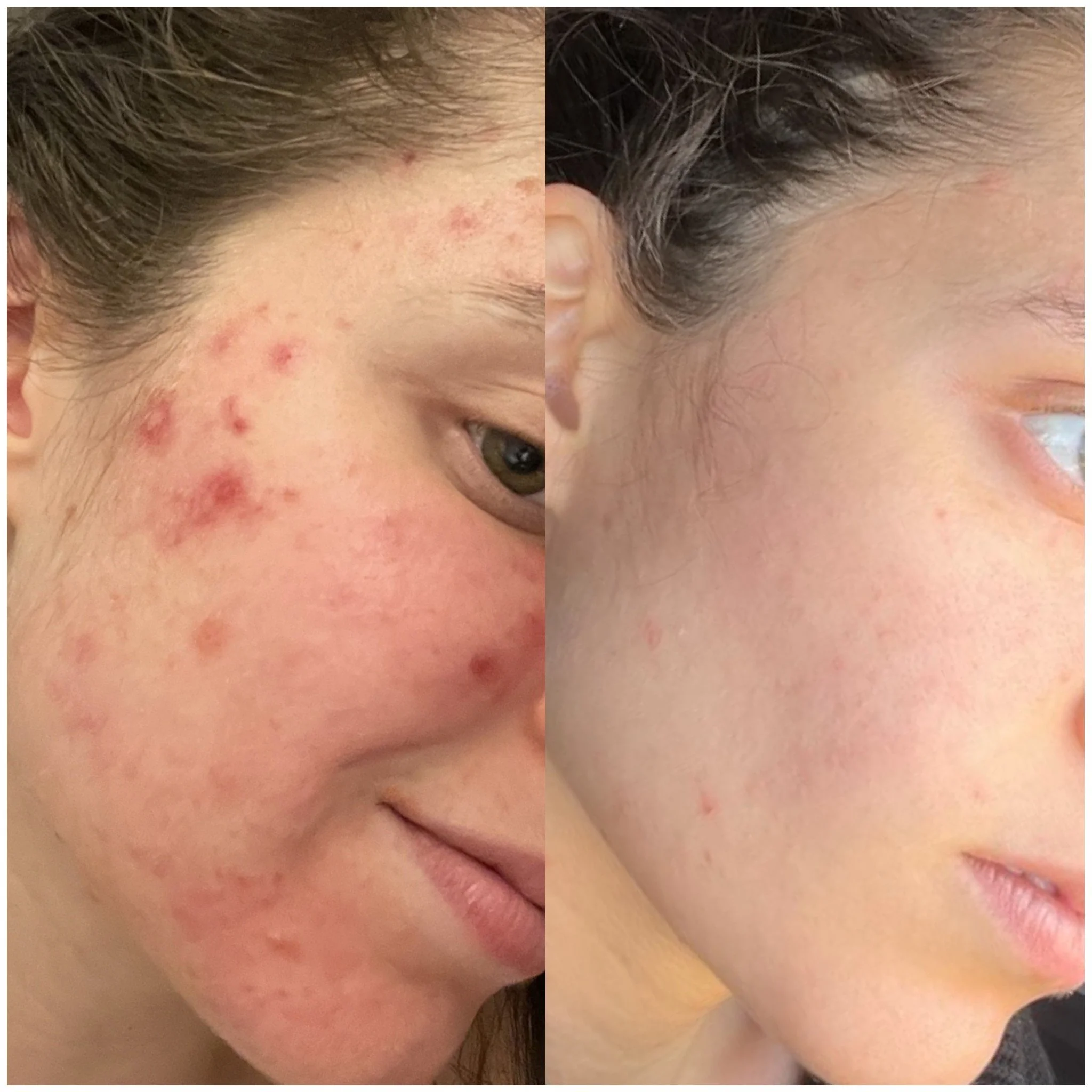 Acne progress