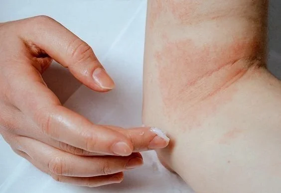 Eczema skincare tips