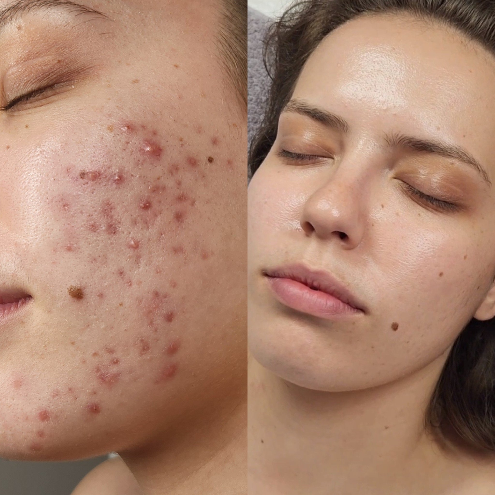 Side-by-side comparison of a woman's face showing severe acne on the left and clear skin on the right. Katey Kristabelle results