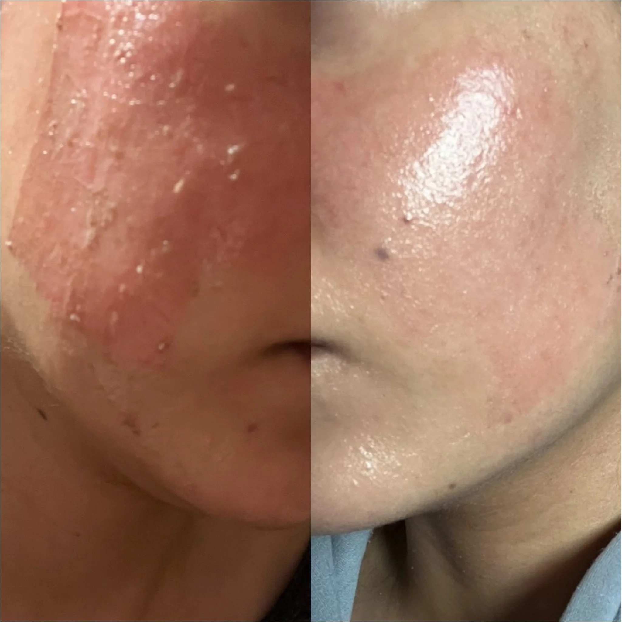Virtual consult + home care results