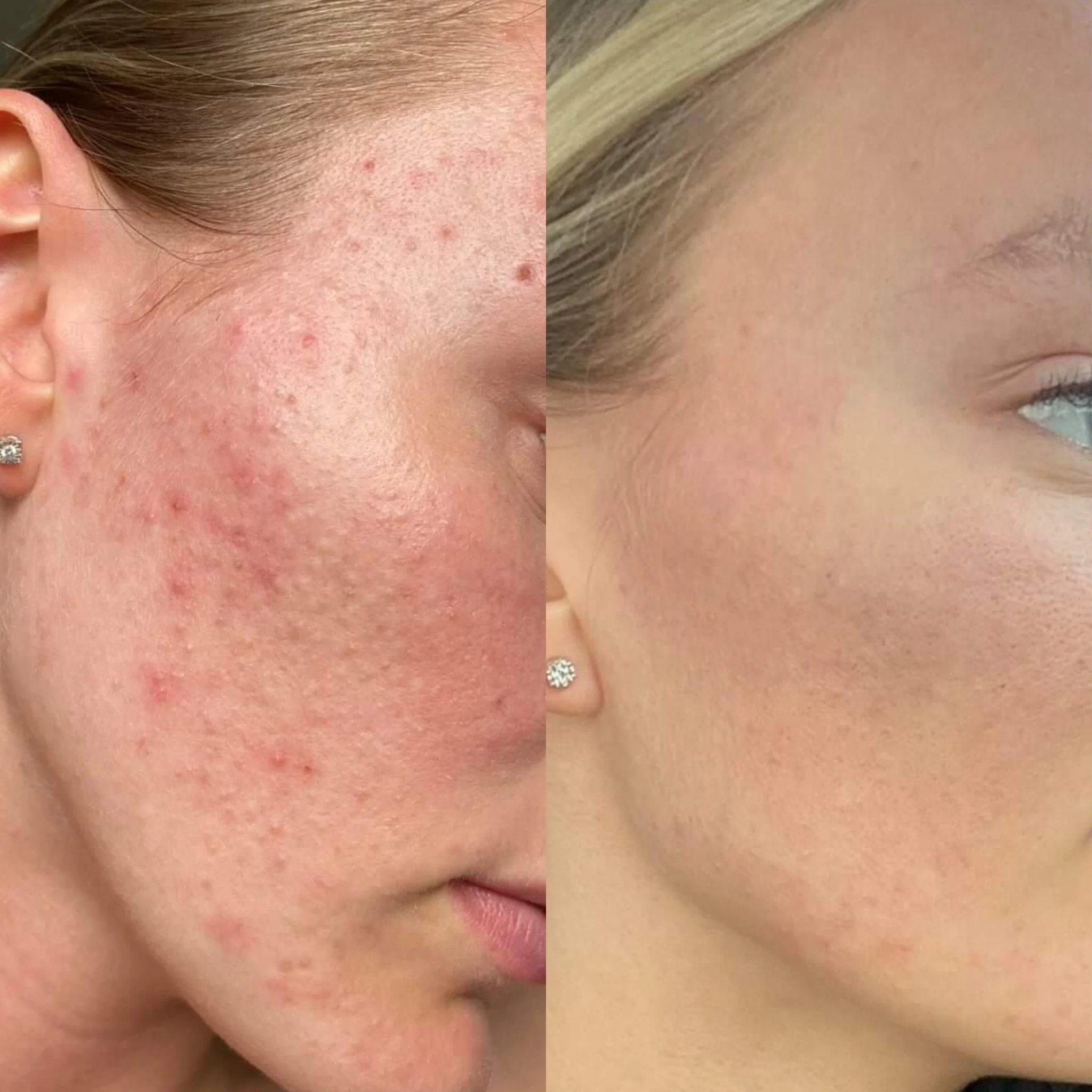 Skin transformation rotating monthly facials + skincare at home