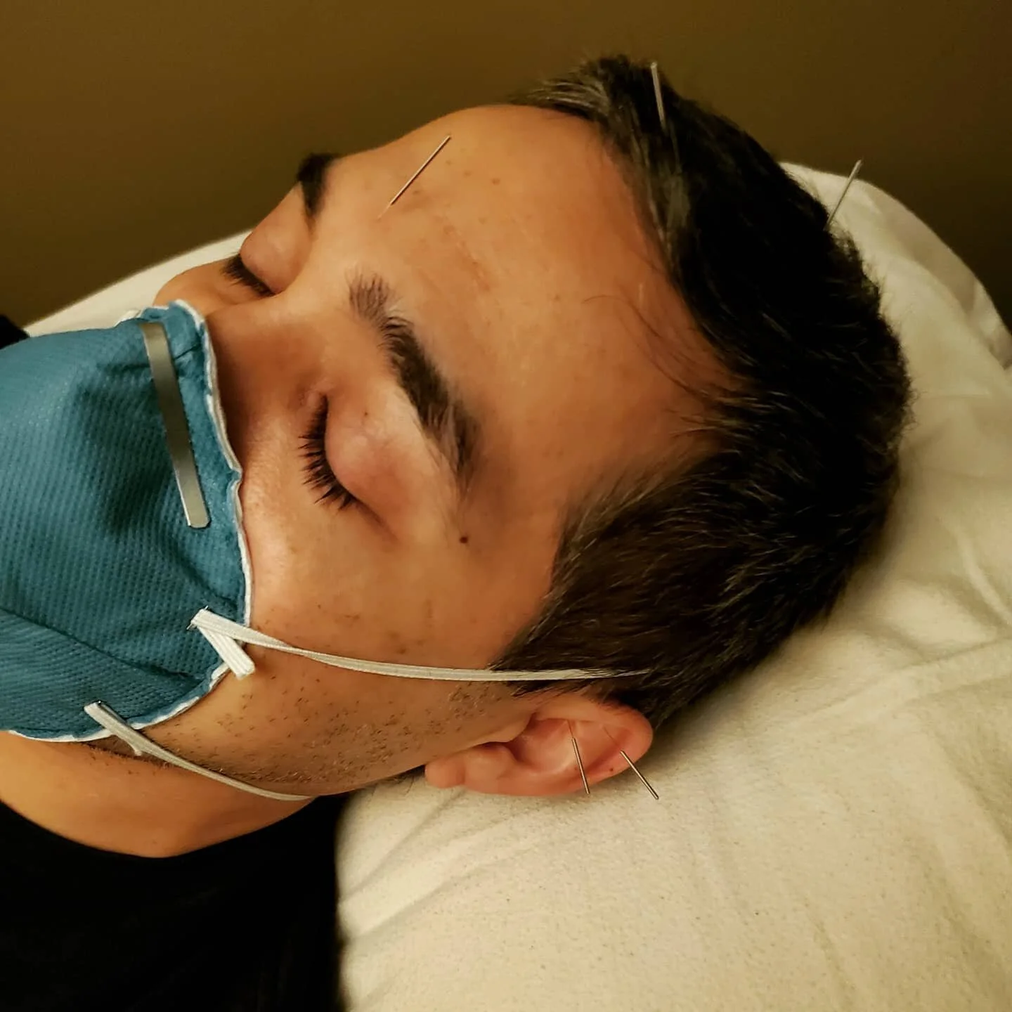 3rd treatment of acupuncture from @alignedmodernhealth. Staff has been great and the lady who is helping me has experience working with veterans. I'm hopeful this will improve my physical and emotional well-being. #wellness #mentalhealth #physicalhea