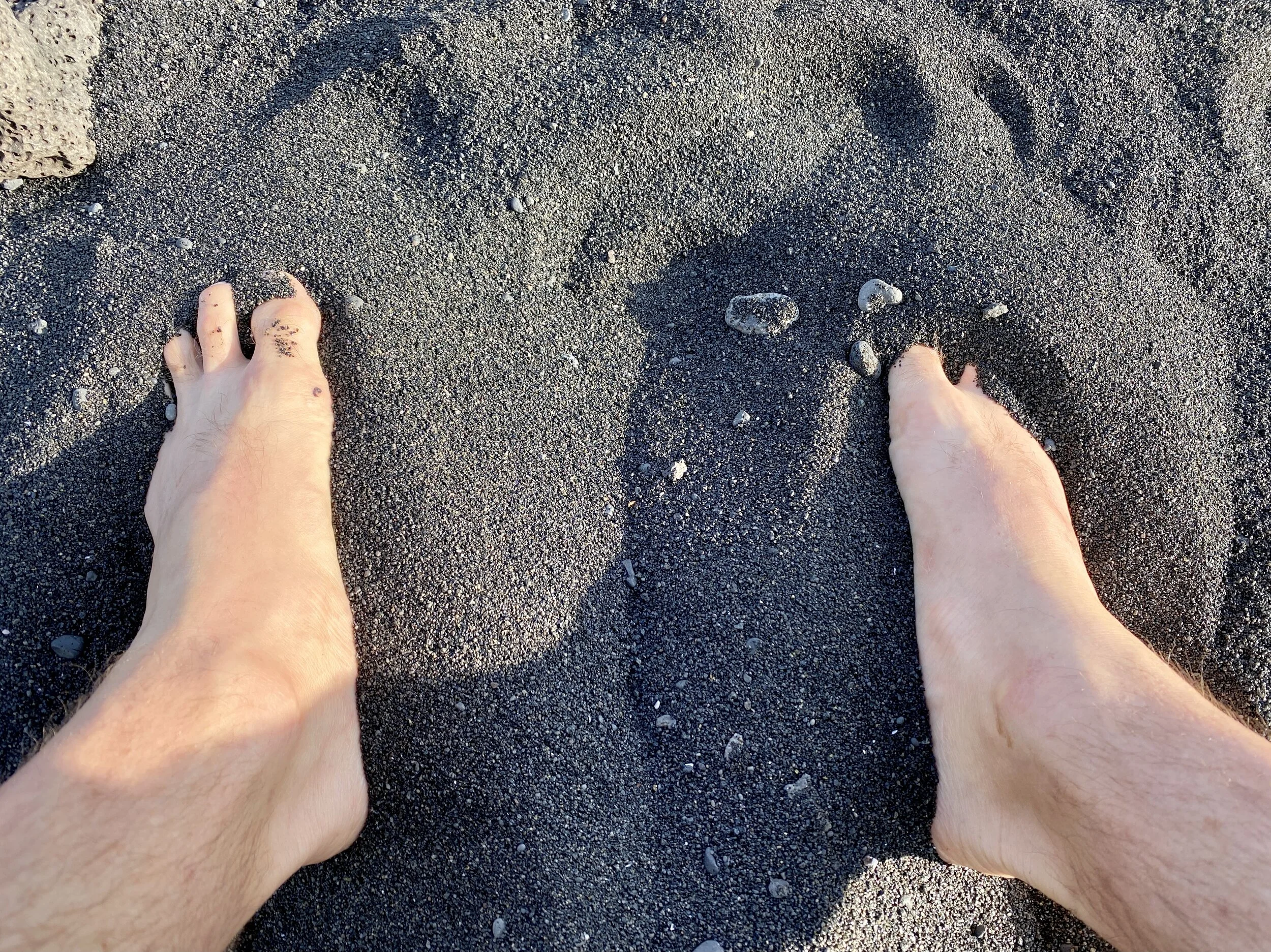 Lisfranc recovery: looking back a year later