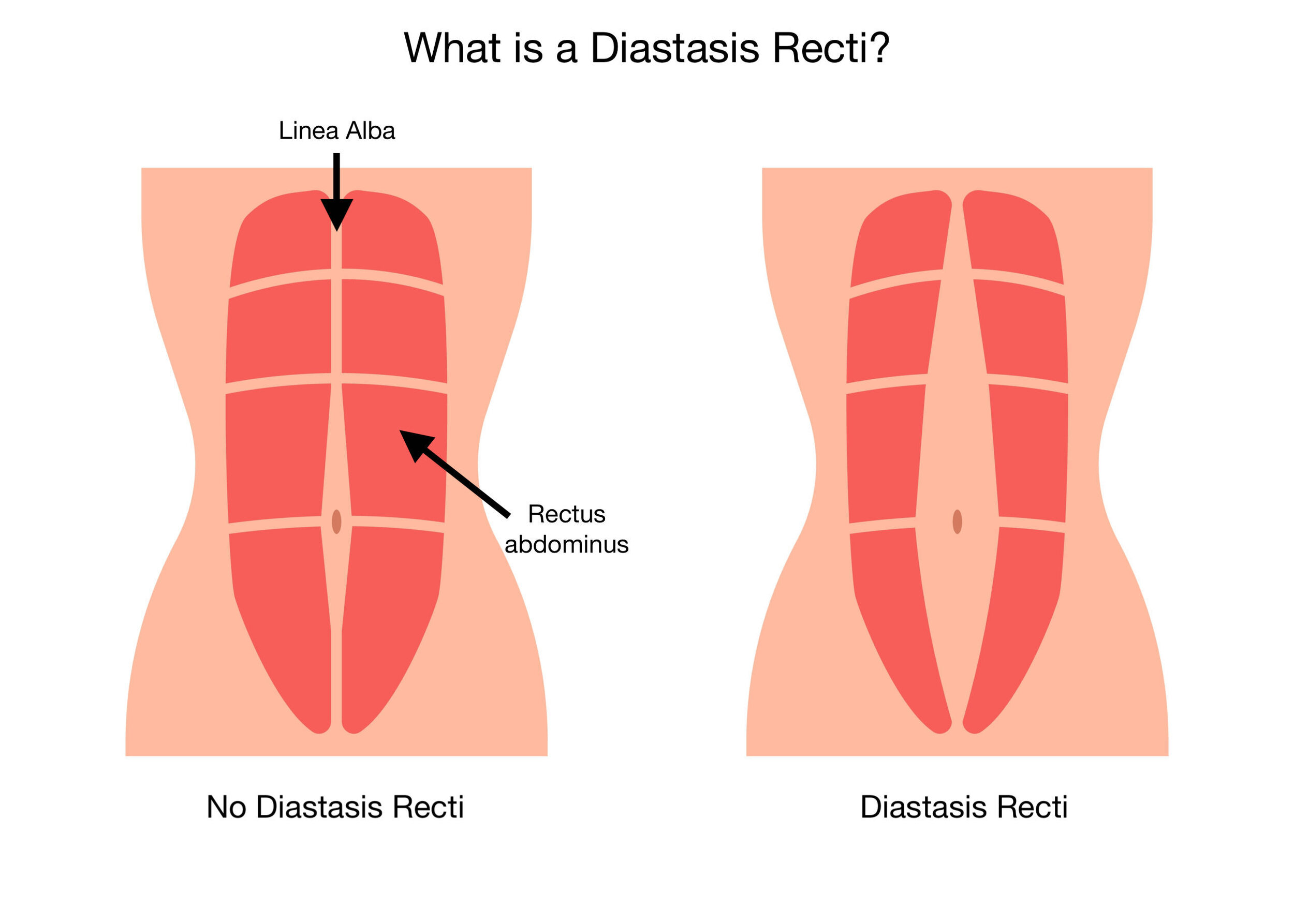Diastasis Recti: Abdominal Separation FAQs