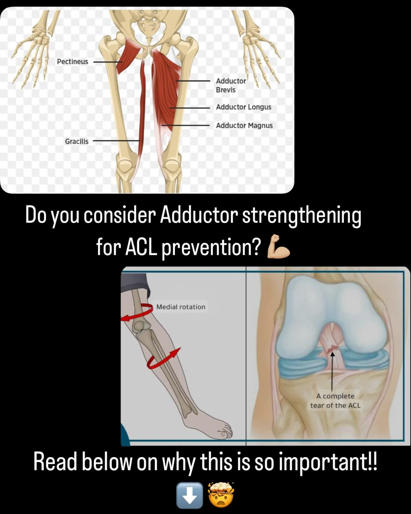 THE IMPORTANCE OF ADDUCTOR STRENGTH FOR ACL:
 💥 1. Pelvic and Knee Stability
Strong adductors help stabilize the pelvis and femur, which in turn controls knee alignment during cutting, landing, and pivoting.
 💥 2. Control of Hip Adduction and Inter