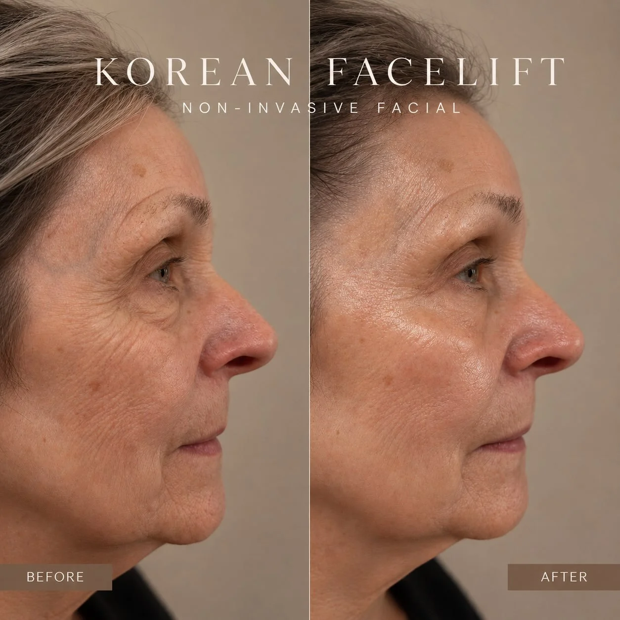 ✨ Lift. Smooth. Glow. ✨

No needles. No downtime. Just the power of Korean skincare. 🤍

Our Korean VTOX Facial is designed to visibly firm, smooth the appearance of fine lines, and leave your skin looking refreshed and radiant after just one treatme