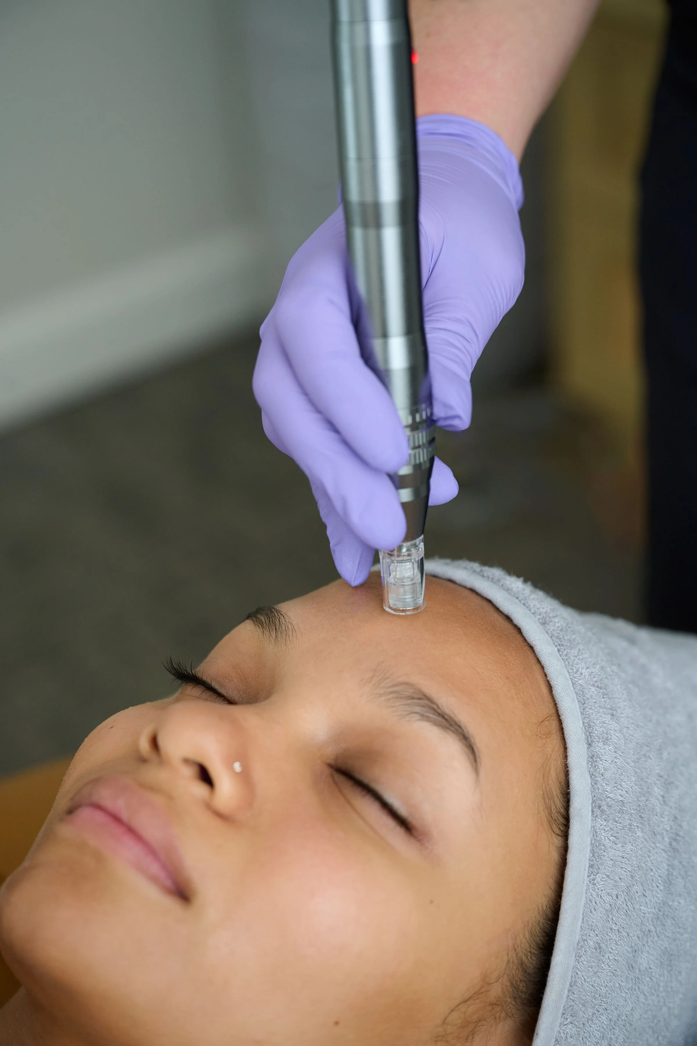 microneedling