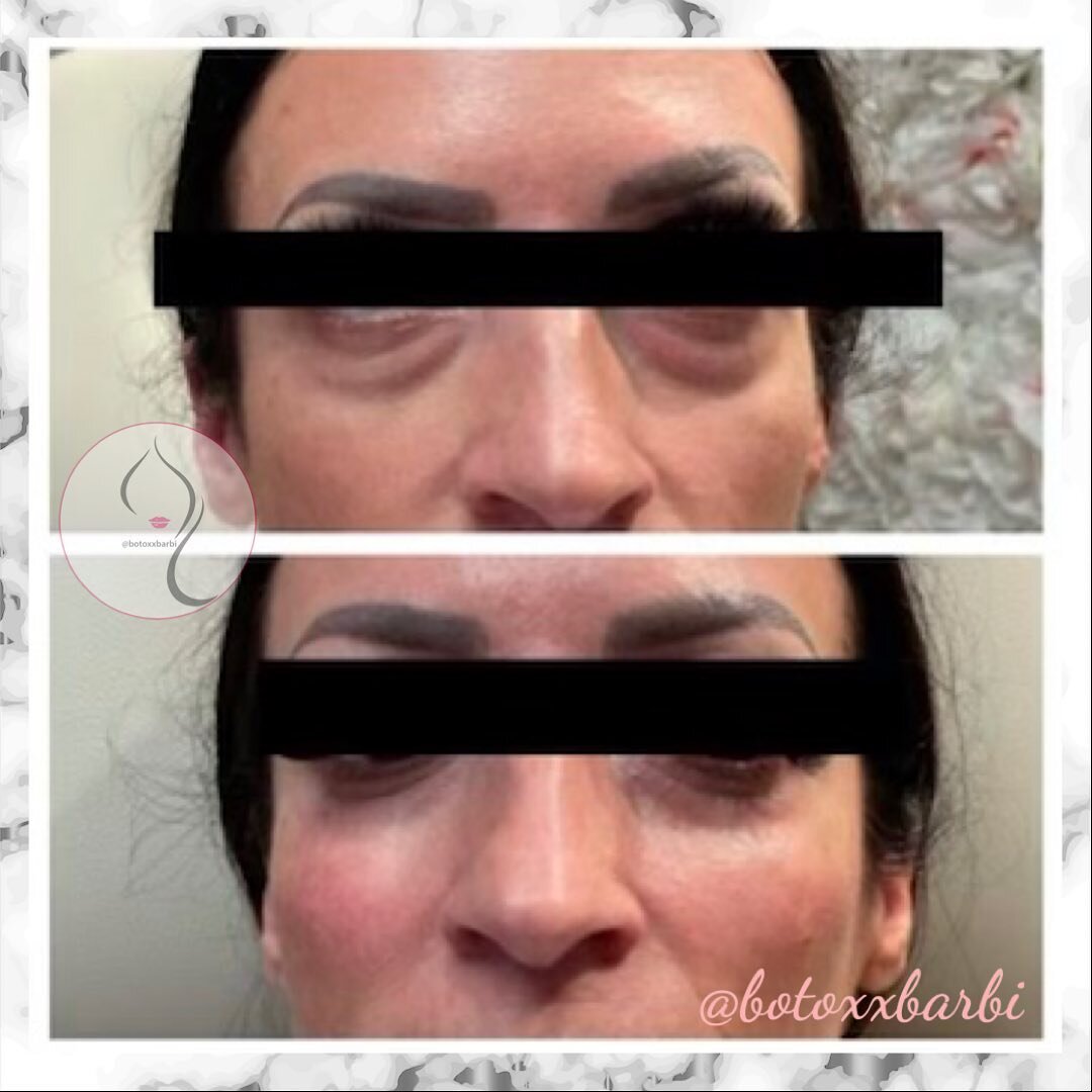 Some Restylane to the tear trough area to make these dark circles and under eye bags disappear!  Topped off with a little sprinkle of cheek filler! 👌🏻✨