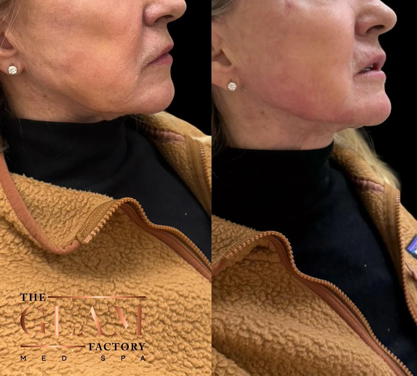 A little jawline, nasolabial and marionette like filler combo can have your before &amp; afters looking like this ⤴️ 

Book yours now so you can be snatched and sleek before the holidays! 🎄

#igotitfrombotoxxbarbi #botoxxbarbi #botoxxbarbi👩🏼&zwj;⚕
