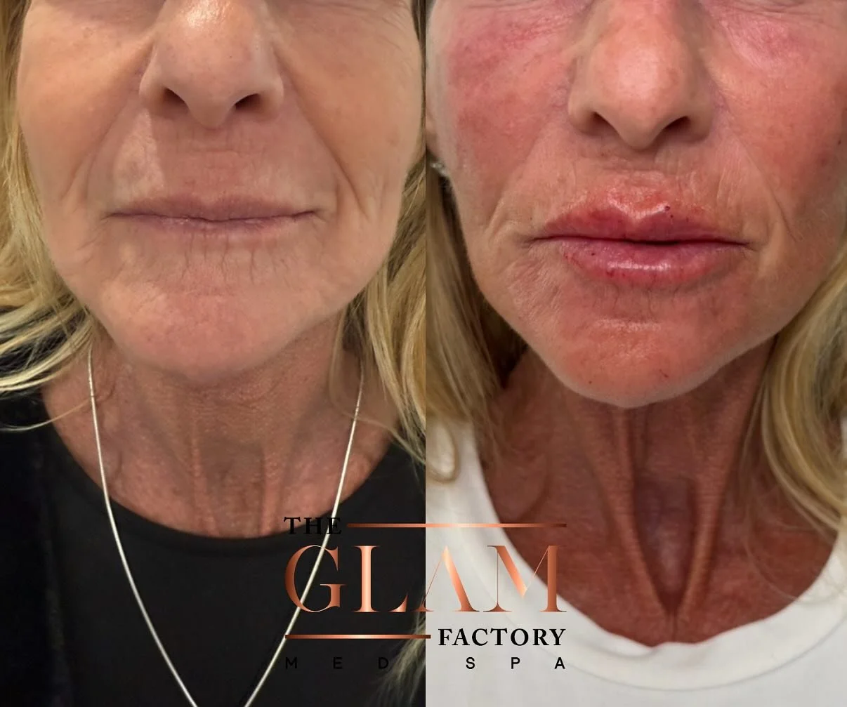 Isn&rsquo;t it amazing what a lil&rsquo; filler can do? Hydration, volume, and a perfect pink shape! 🍒💋

#igotitfrombotoxxbarbi #botoxxbarbi #botoxxbarbi👩🏼&zwj;⚕️ #lipfiller #bostonlipfiller #bostoninjector #bostoninjectables #cosmeticinjector #c