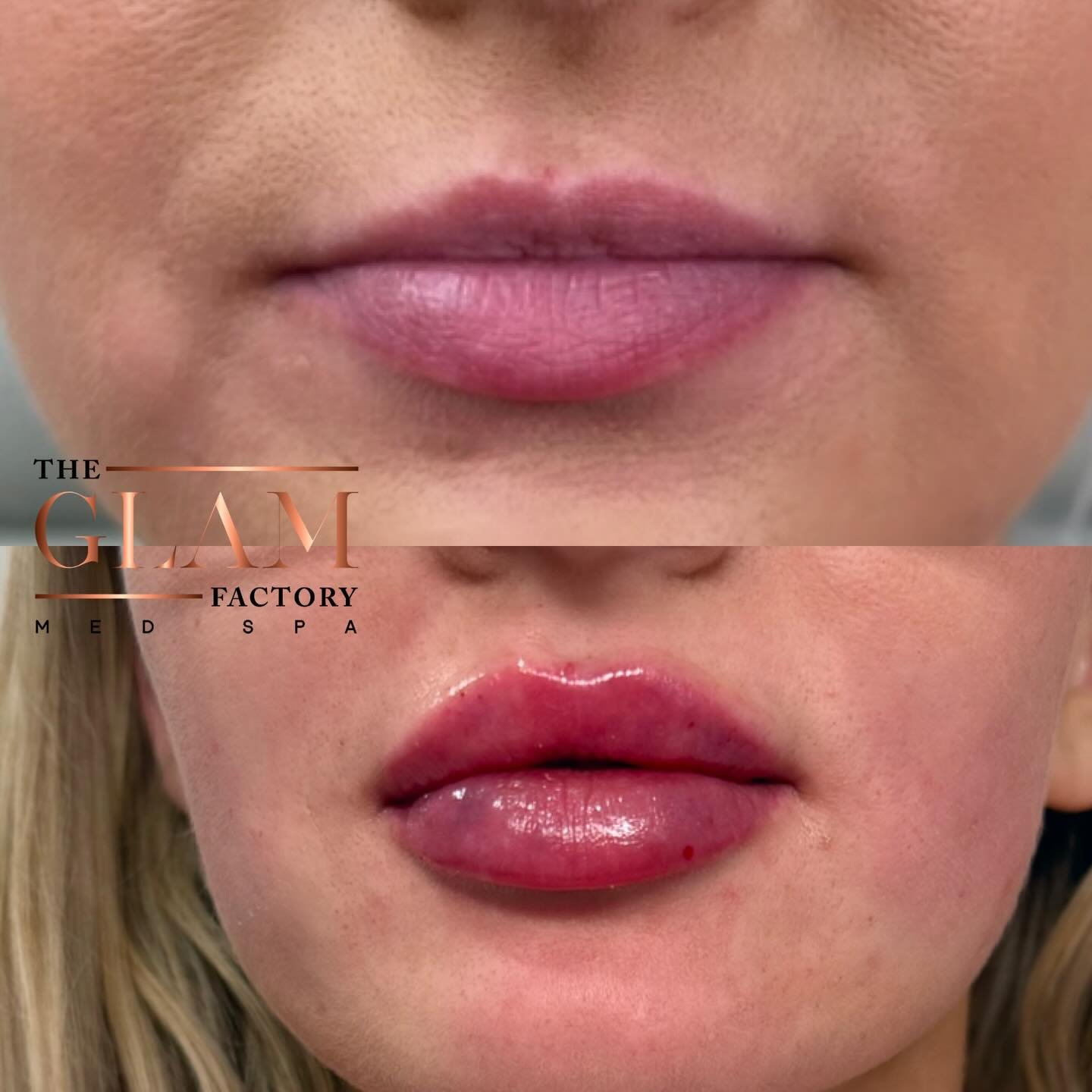 Pumped lips fresh off the needle 💉✨ Say hello to the new pout. 👋🏻💋

#freshlips #igotitfrombotoxxbarbi #botoxxbarbi👩🏼&zwj;⚕️ #braintreema #bostonmedspa