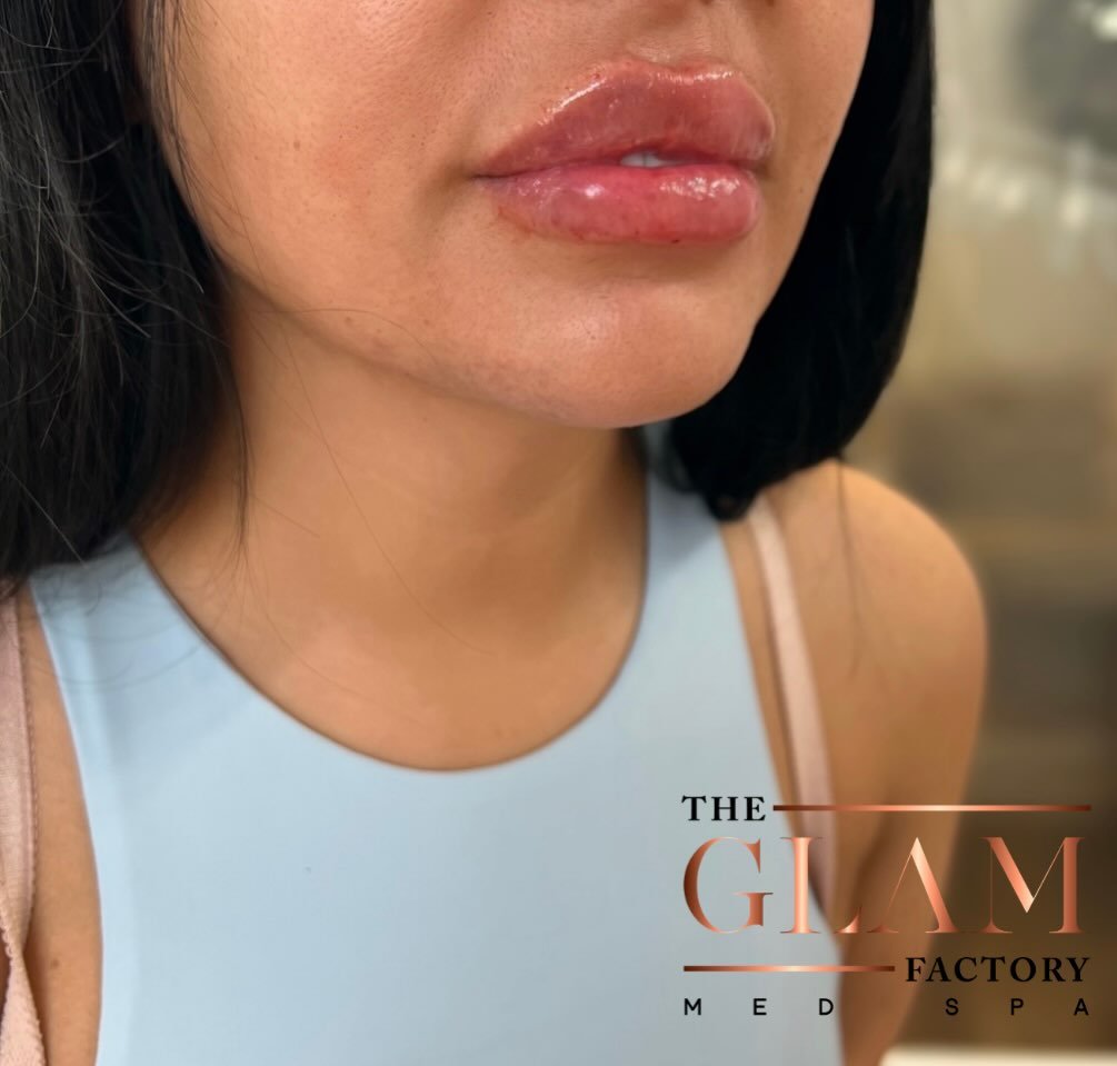 Who cares if Valentine&rsquo;s Day is over? I&rsquo;m here to give you the lips you&rsquo;ll love every day of the year! 🩷💉💋

#igotitfrombotoxxbarbi #botoxxbarbi👩🏼&zwj;⚕️ #lipfillerboston #bostonlipfiller #lipsoftheday