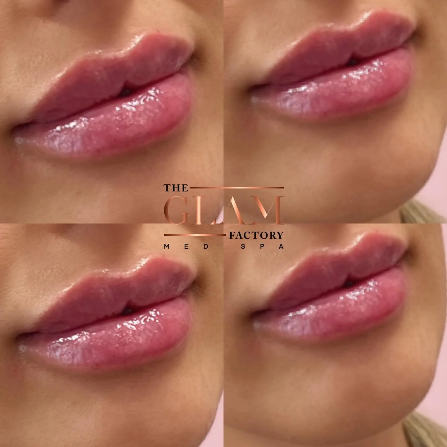 Trends come and go, but a perfect kissable pout? Forever the moment. Classic, confident, and always in style 💄

#igotitfrombotoxxbarbi #botoxxbarbi👩🏼&zwj;⚕️ #botoxxbarbi #braintreema #bostonmedspa